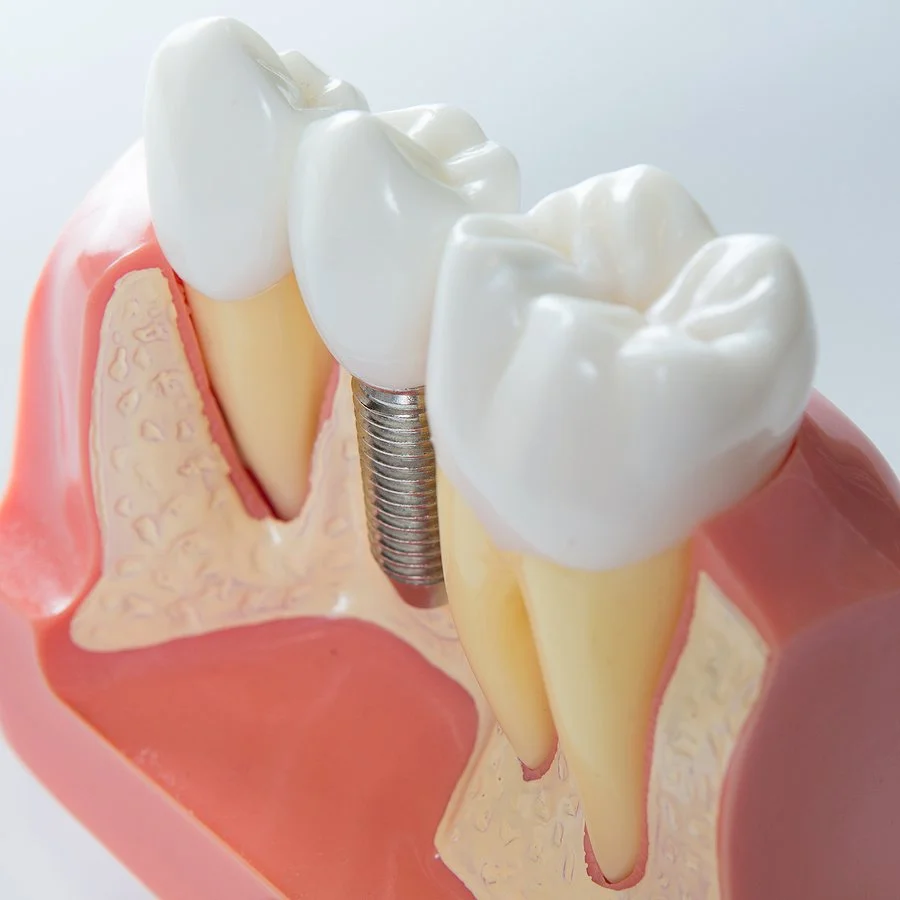 What Do Dental Implants Look Like? A Simple Guide to Appearance and Results