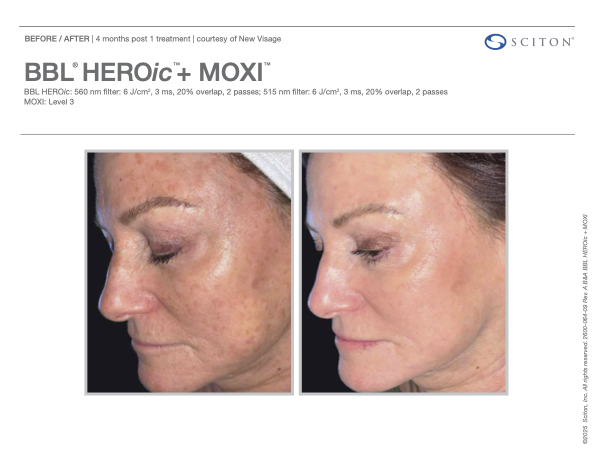 Why We Combine MOXI + BBL for Our Most Powerful Skin Transformations
