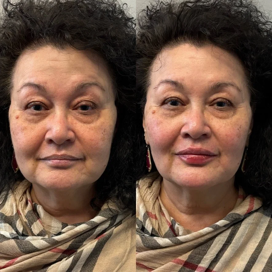 Side-by-side comparison of a woman before and after cosmetic treatment, showing improved skin appearance with reduced wrinkles and more even skin tone.