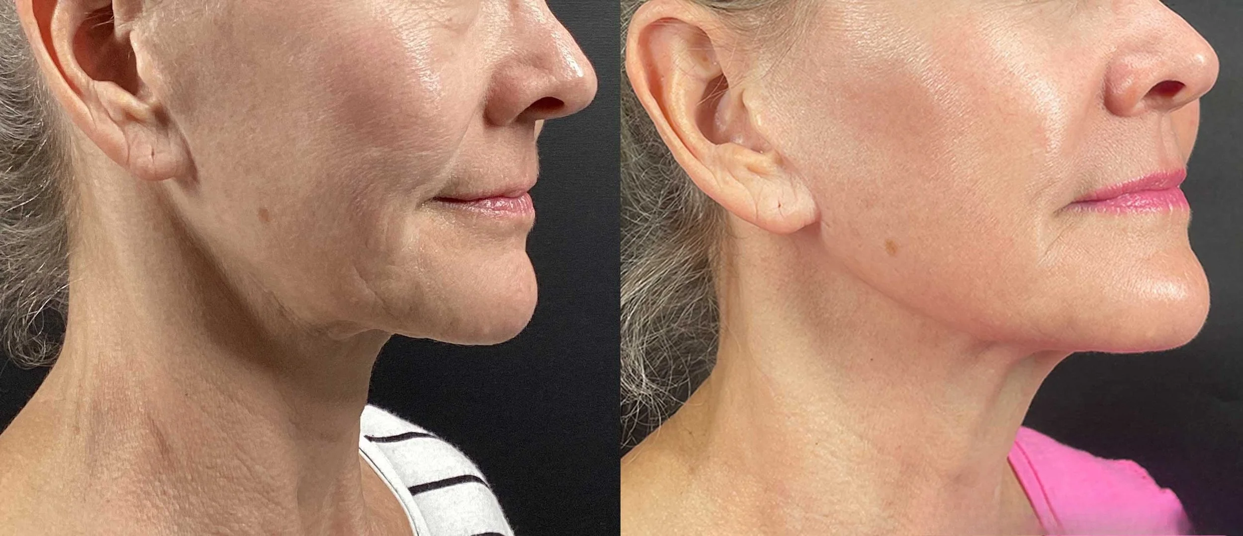 Side-by-side comparison of a woman's face before and after a cosmetic procedure, showing improved skin texture and appearance.
