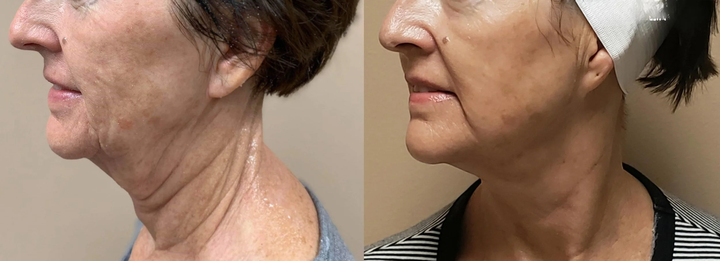 The Beauty of Balance: Why Hyaluronic Acid Fillers Are the Gold Standard in Aesthetic Medicine