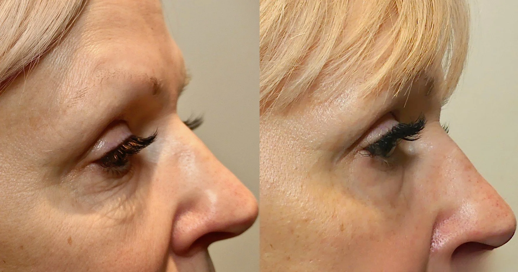Side-by-side close-up images of skin, showing before and after results of a skin treatment.