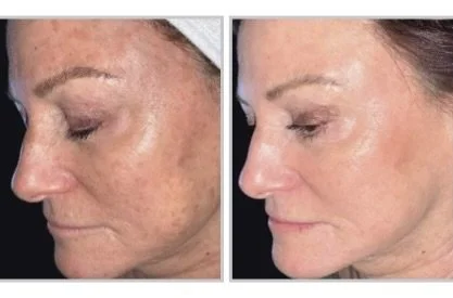 Side by side comparison of a middle-aged woman before and after skincare; both images show her smiling with her eyes closed, wearing earrings and necklaces, with different backgrounds.