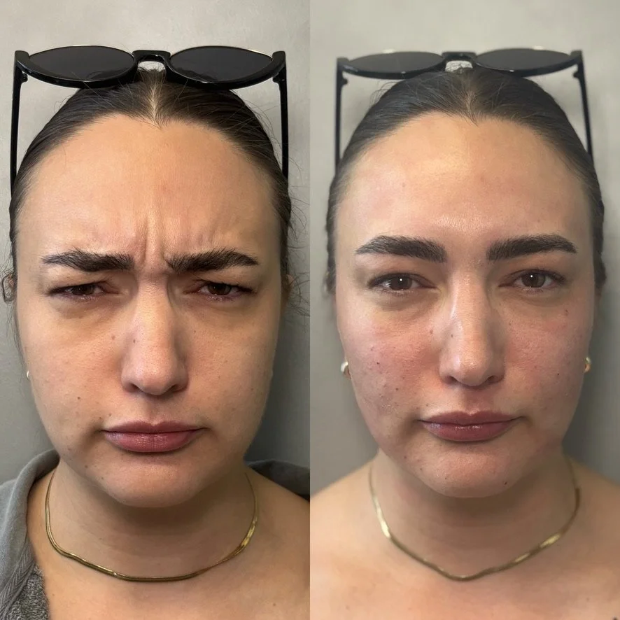 Before and after photos of a woman with changes in facial appearance, including eyebrow shape and skin texture.