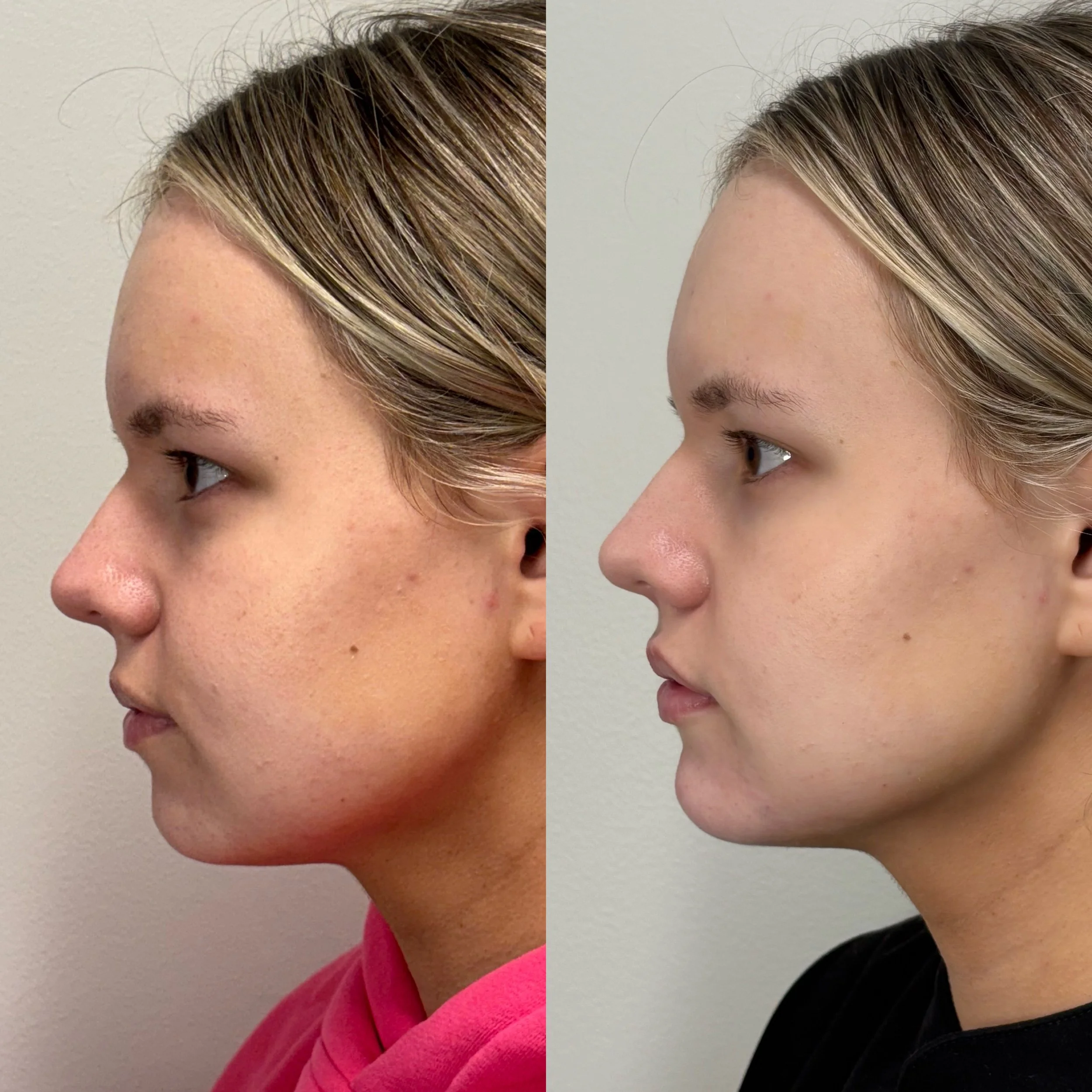 Side-by-side comparison of a woman's face before and after skincare, showing clearer and smoother skin in the after image.
