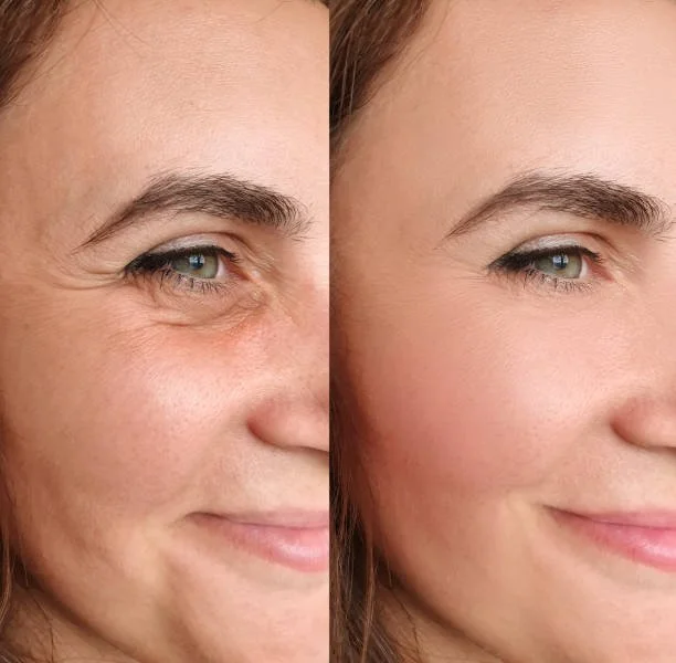 Close-up of a woman's face showing a before-and-after comparison of skin with fewer wrinkles and smoother texture after skincare or treatment.