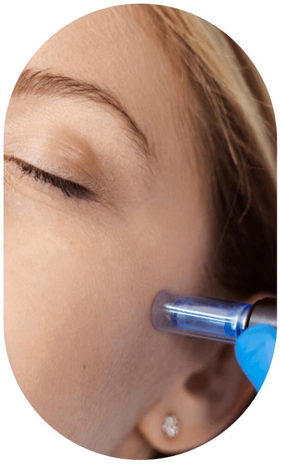 Close-up of a person's face with eyes closed, receiving a Botox injection in the cheek area from a healthcare professional wearing gloves.