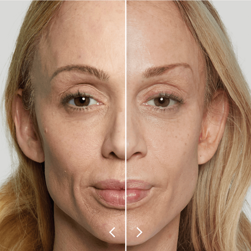 Side-by-side comparison of a woman's face showing before and after skin treatment, with smoother and clearer skin in the after image.