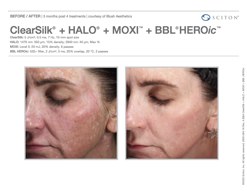 Why We Choose BBL HEROic and MOXI® Over Traditional IPL