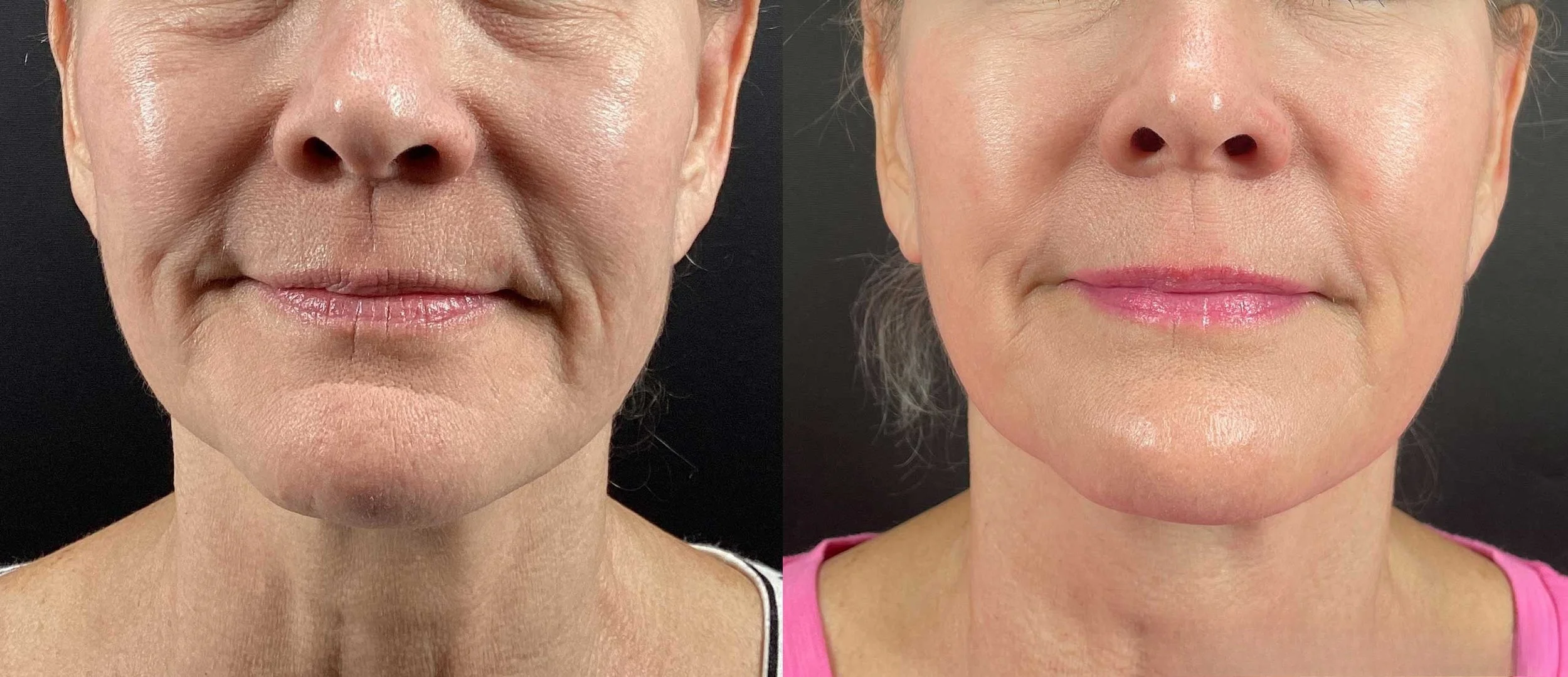 Comparison of woman's facial skin before and after a skin treatment, showing reduced redness and improved skin texture.