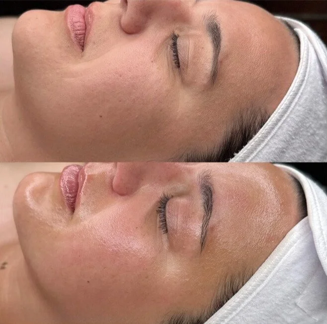Before and after images of a woman's face showing skin treatment, with smoother and clearer skin in the after photo.