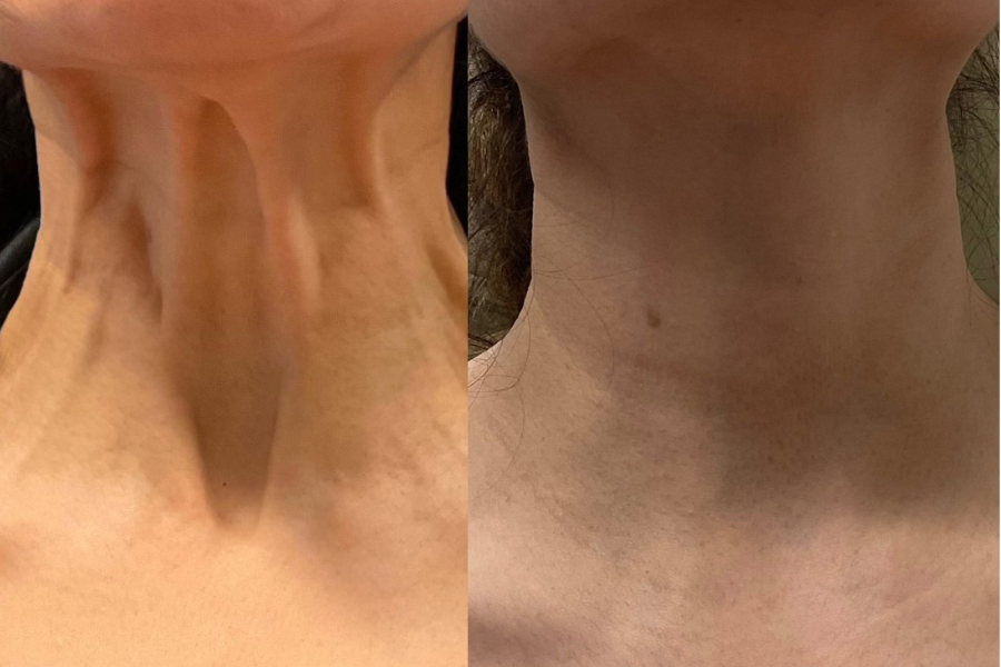 Comparison of a person's neck before and after a cosmetic treatment, showing improvements in skin texture and appearance.