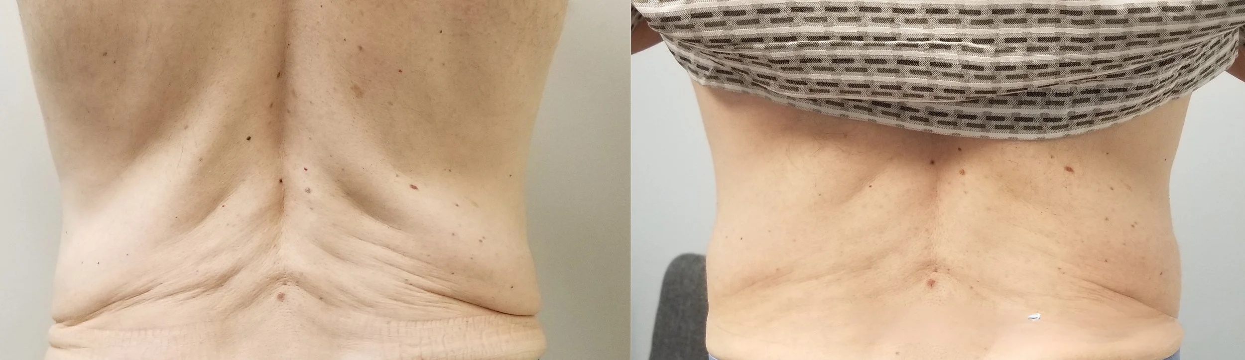 Comparison of a person's back before and after weight loss, showing a reduction in back fat and improved skin tightness.
