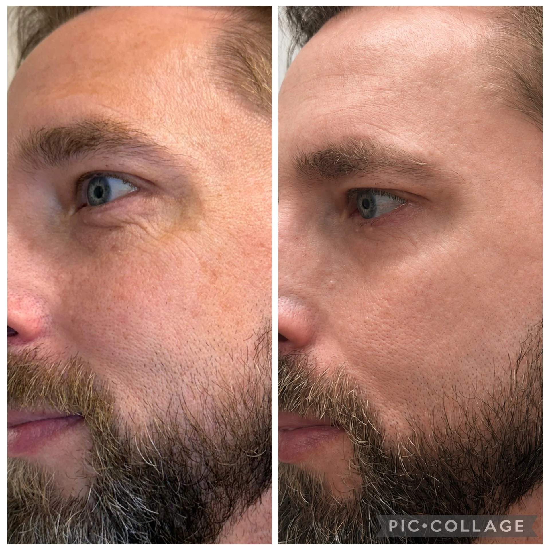 One BBL Treatment
