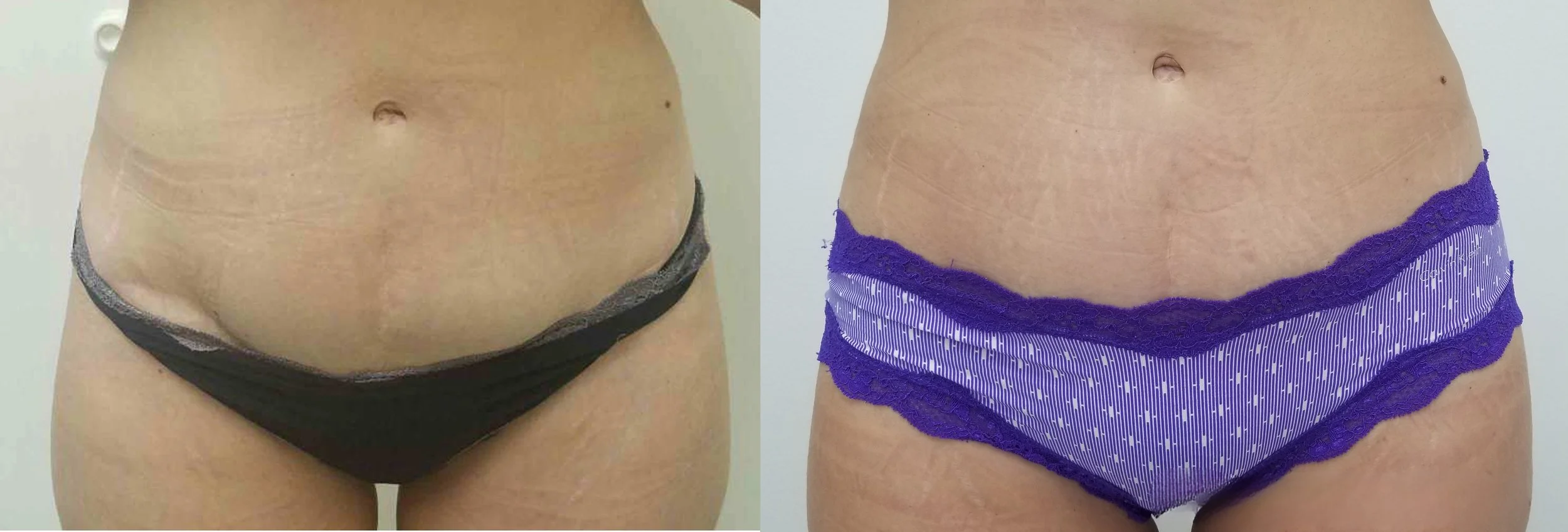 Side-by-side comparison of a woman's face showing before and after skin treatment, highlighting improvements in skin texture and clarity.