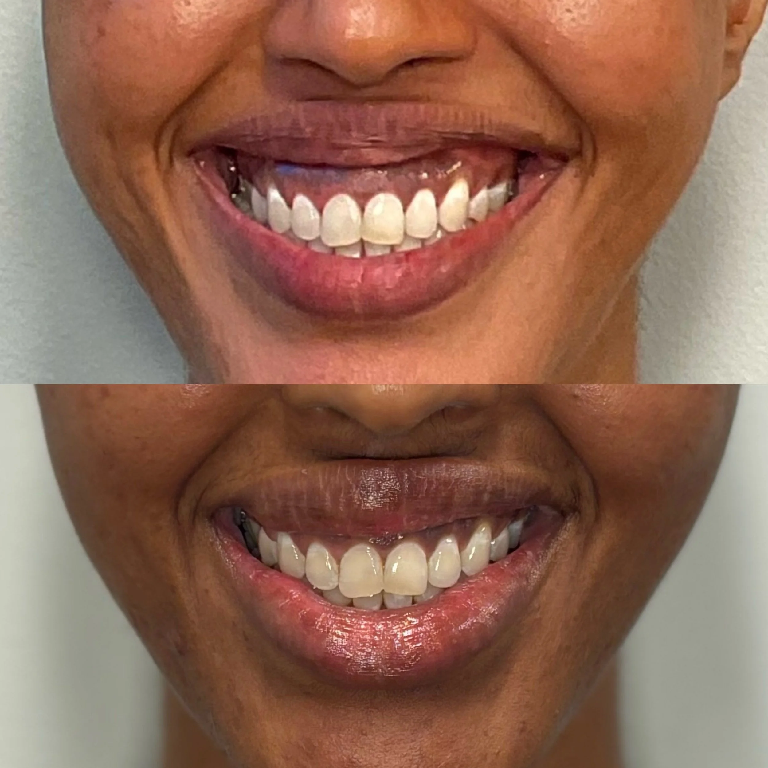 Close-up of two smiling mouths showing teeth, one with lipstick and the other without, against a plain background.