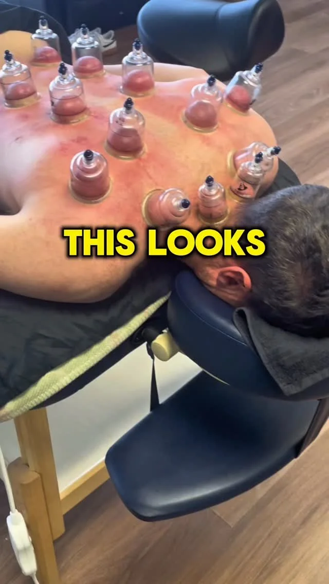 Seems a bit alternative but this really works and anything that’s going to allow me to play golf longer and injury free I’m all for! #pureactivation #cuppingtherapy #myofascialrelease #golffitness #strengthandconditioning @pureactivation