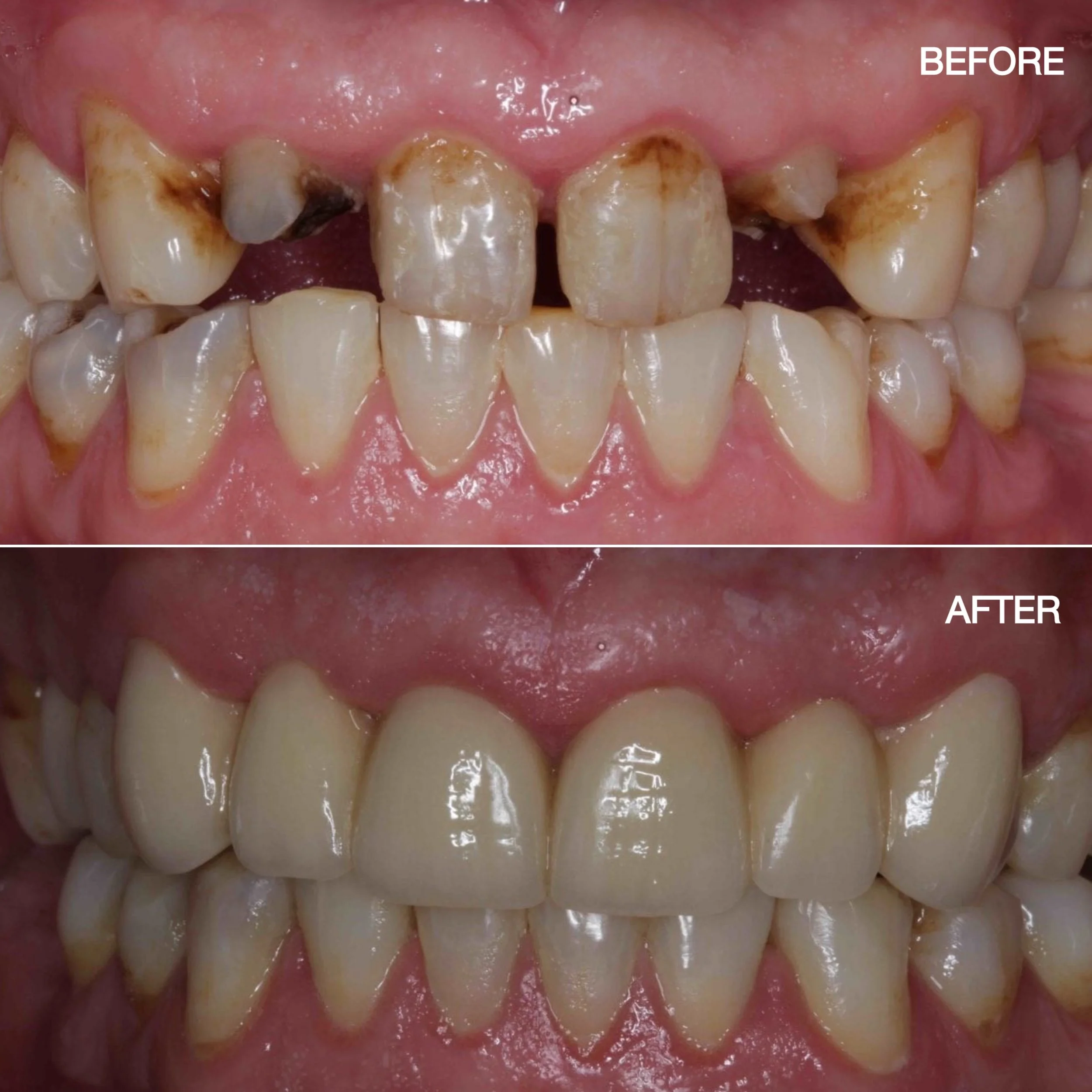 Complete Dentistry_Smile Gallery_DentistEdmondsWa11.jpg