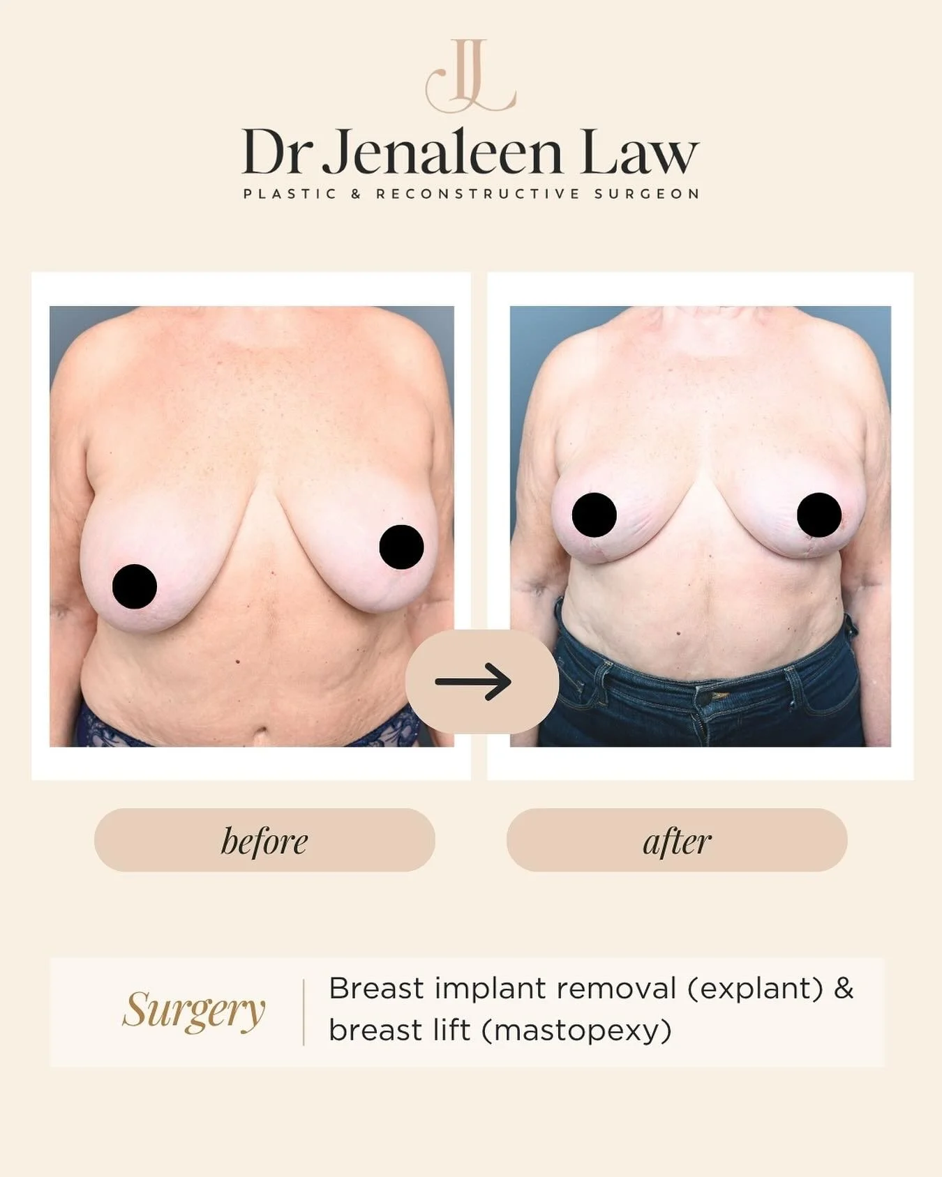 BACKGROUND: This lovely patient had cosmetic breast augmentation surgery decades ago and saw me following rupture of both implants, with concerns of silicone leak, pain, implant shifting, and nipple asymmetry.

SURGERY: She underwent one operation fo
