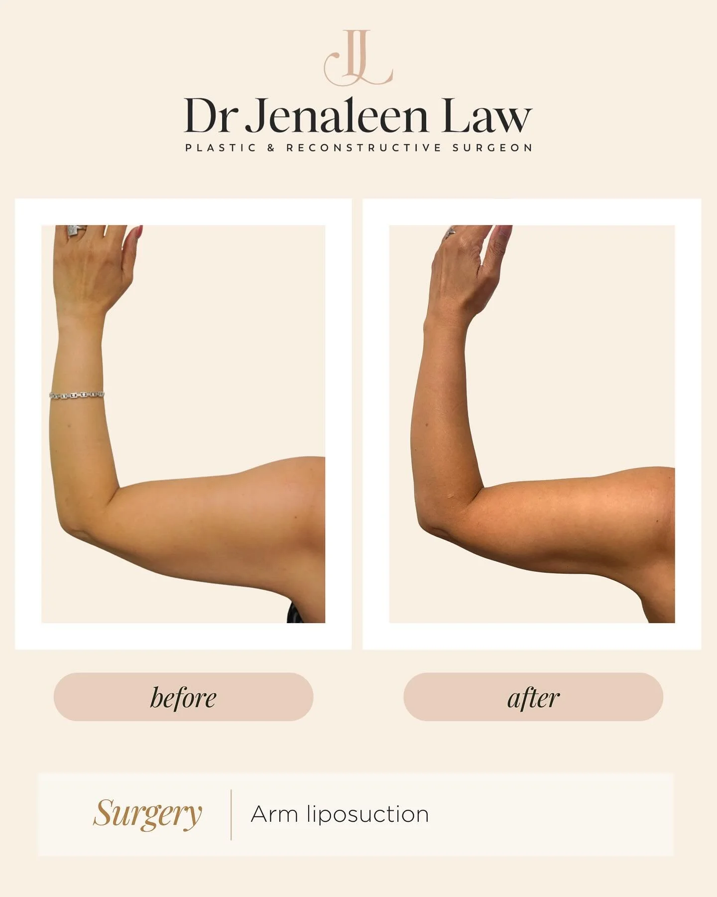 This lady is three months post arm liposuction. She was a good candidate for the procedure &mdash; a healthy non-smoker with stable weight and good skin elasticity. Her goal was to improve arm contour and definition, rather than to use liposuction as