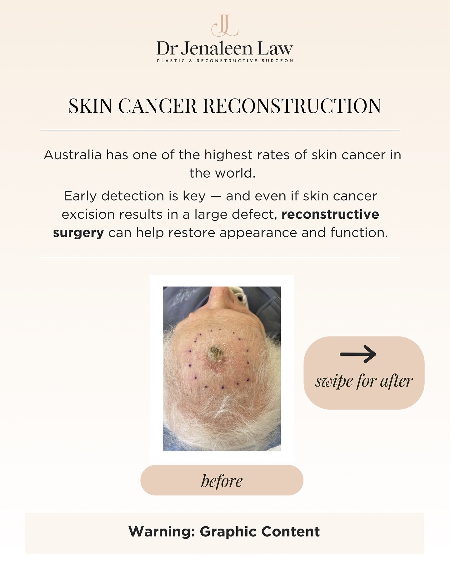 With the recent hot and sunny weather ☀️ I thought it would be a good time to remind everyone to stay sun safe and to share a post related to skin cancer.

This patient underwent Mohs excision of a scalp/forehead skin cancer by the dermatologist and 