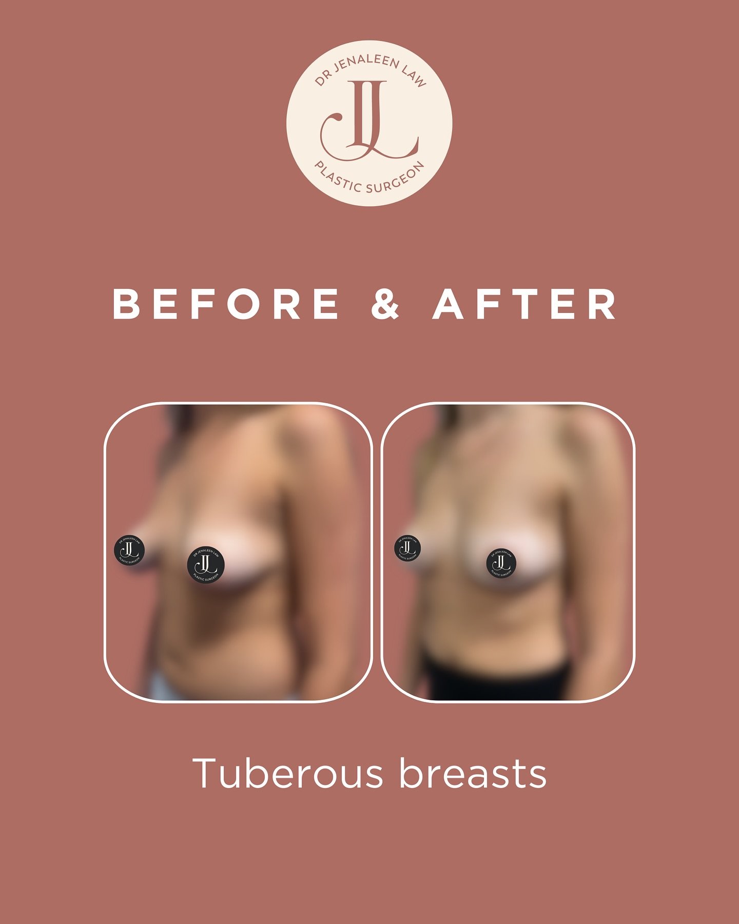 This patient in her 20s underwent correction of tuberous breasts with:
* Autoaugmentation (using her own breast tissue to create a more proportional breast shape).
* Areolar reduction and lift. * Fat grafting in each breast.  Pre and post op photos a