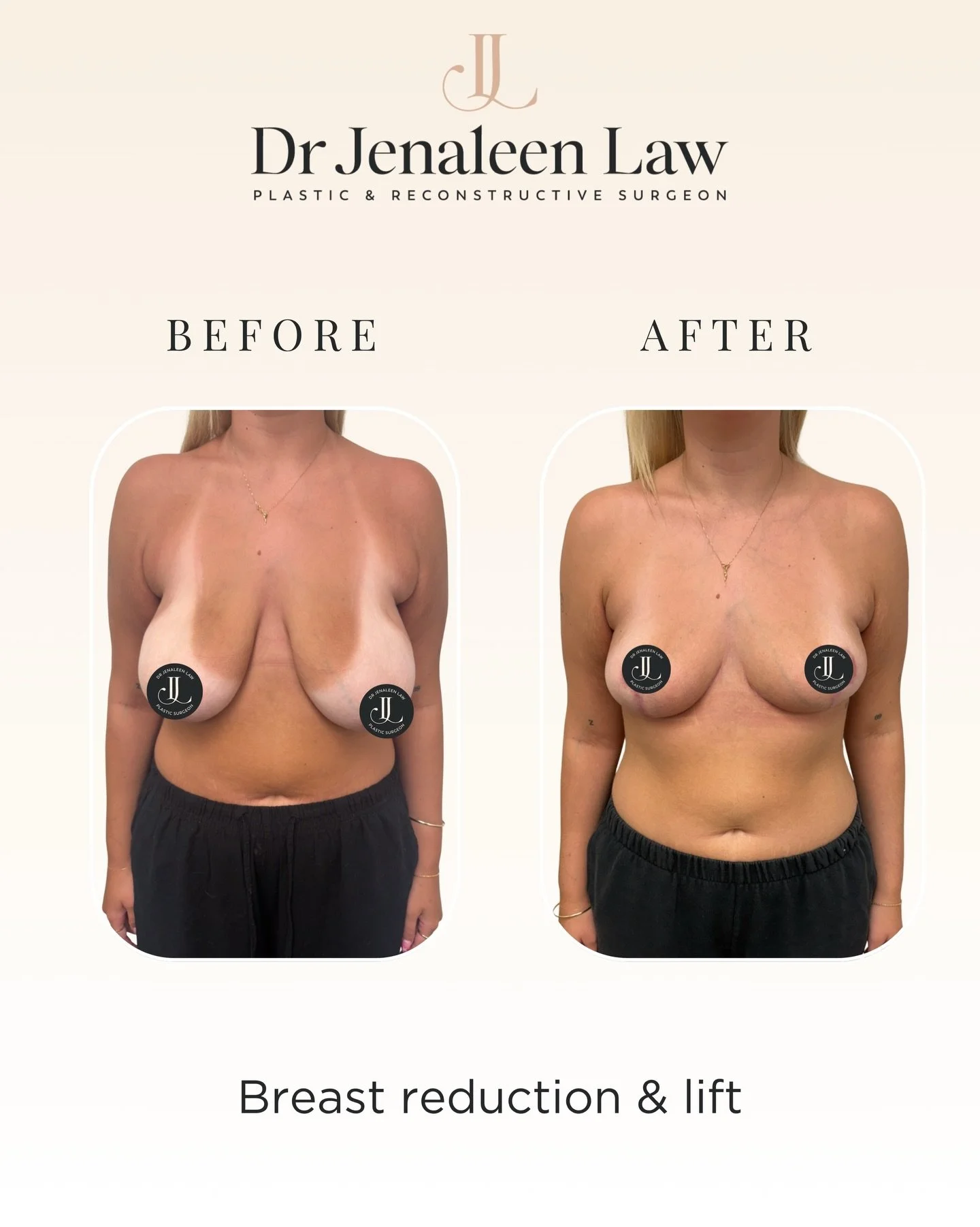 This patient in her 20s is three months following bilateral breast reduction surgery.

She had size E-F breasts, complained of pre-operative symptoms of upper back and neck pain, bra strap grooving, and rashes in the breast crease.

She had 265 grams