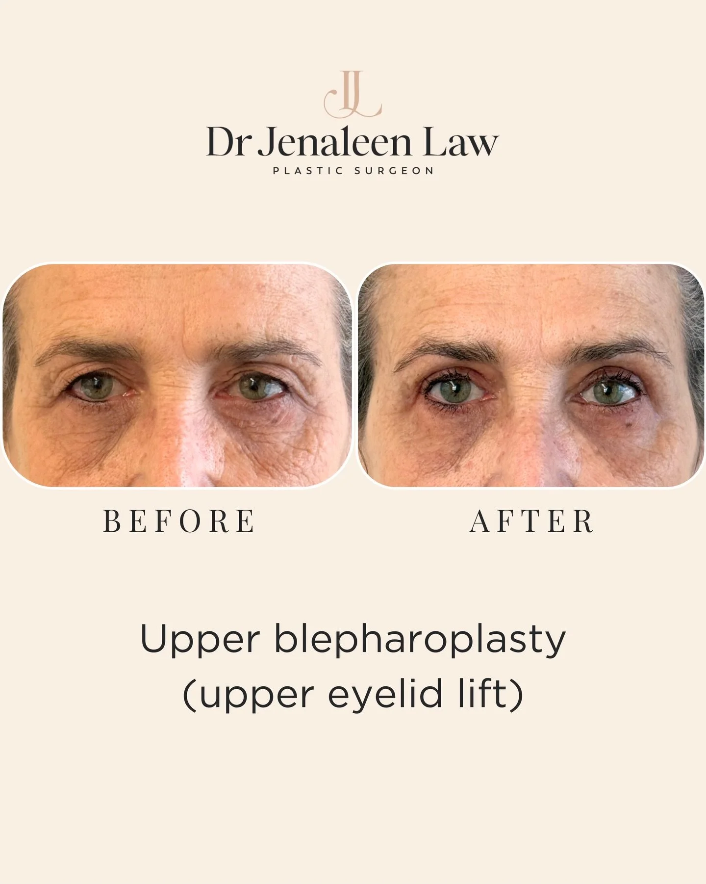Our lovely patient had significant excess upper eyelid skin that was affecting her vision. The skin was resting over her lash line, limiting her upper field of view and making everyday tasks like driving more difficult. Applying mascara was also a ch