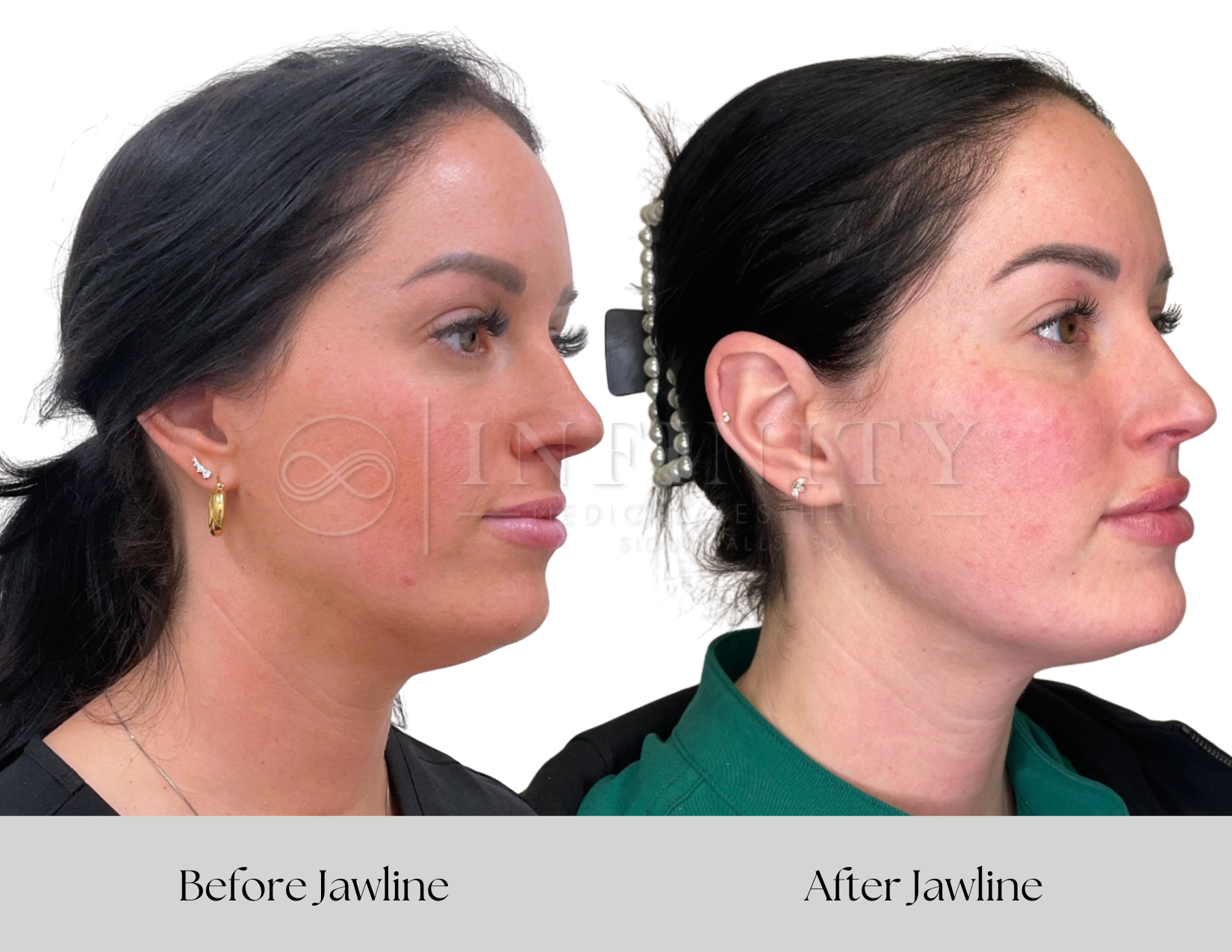 Side-by-side comparison of a woman’s profile before and after jawline treatment. The left shows the woman in June with a less defined jawline, and the right shows her 30 days later with a more sculpted jawline. Both images highlight changes in facial contour.