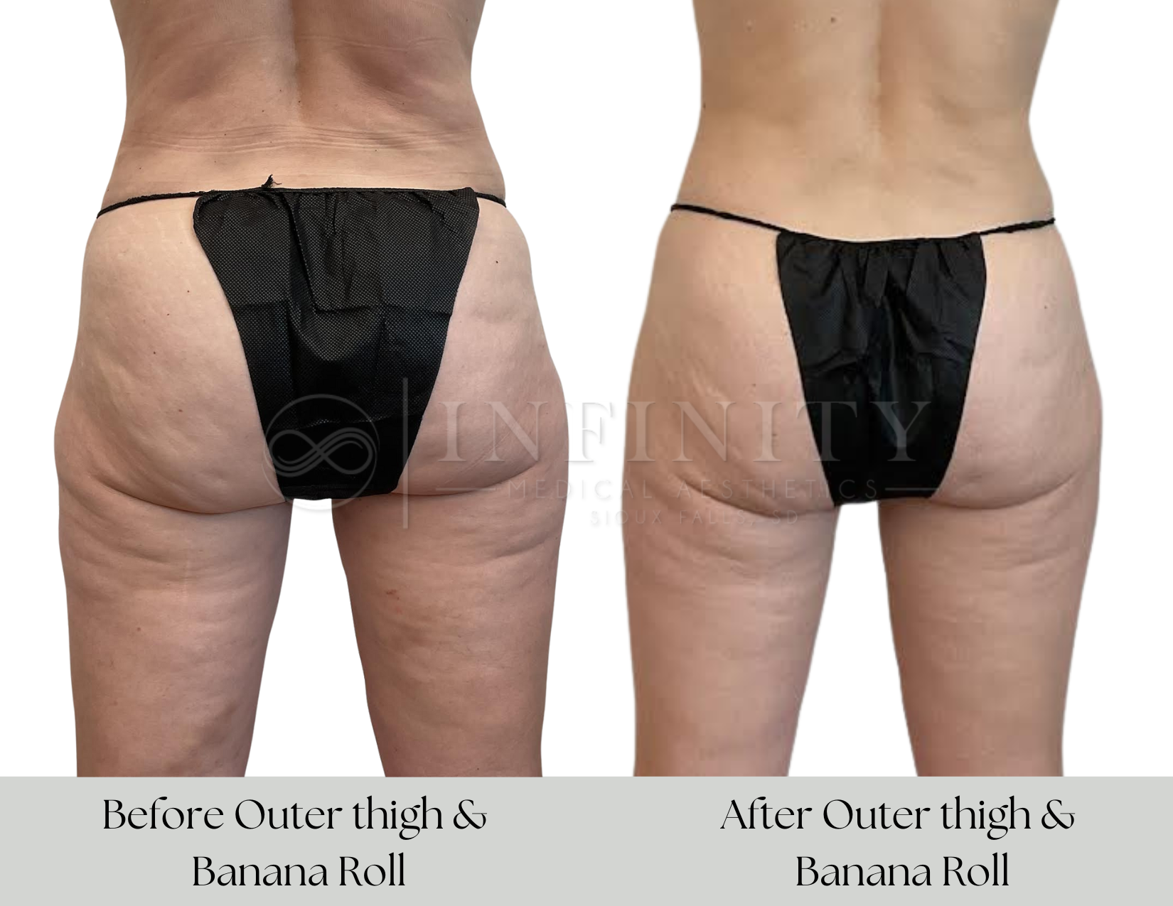 Side-by-side comparison of a woman's lower body before and after a treatment, showing reduction in outer thigh and buttock fat, with text indicating the result is from a 'Banana Roll' treatment after completing a program.