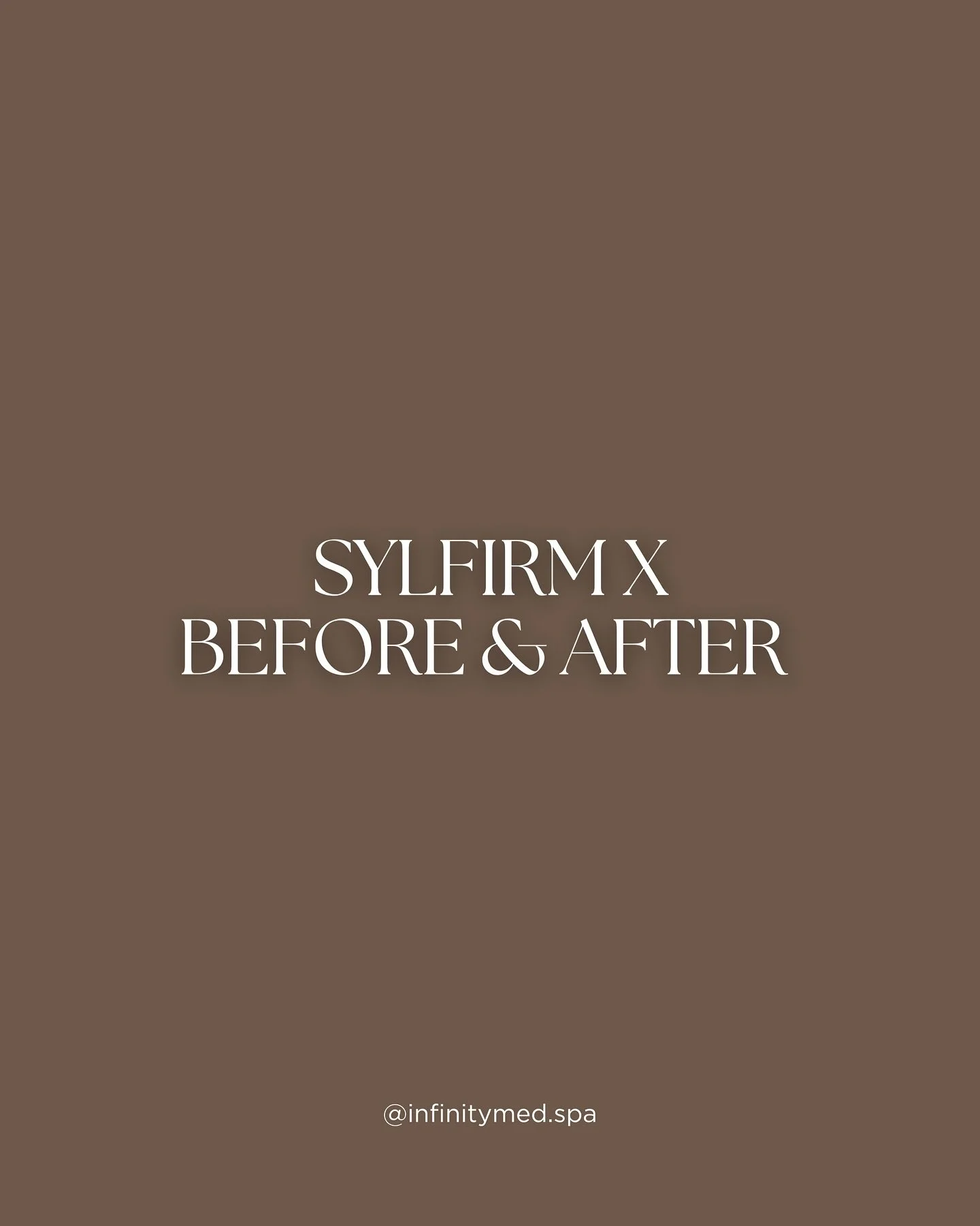 Sylfirm X &mdash; our go-to for tightening, lifting, and restoring skin tone. This client&rsquo;s results show the power of consistency and collagen rejuvenation. 

This advanced RF microneedling treatment targets skin laxity, texture, and redness fo