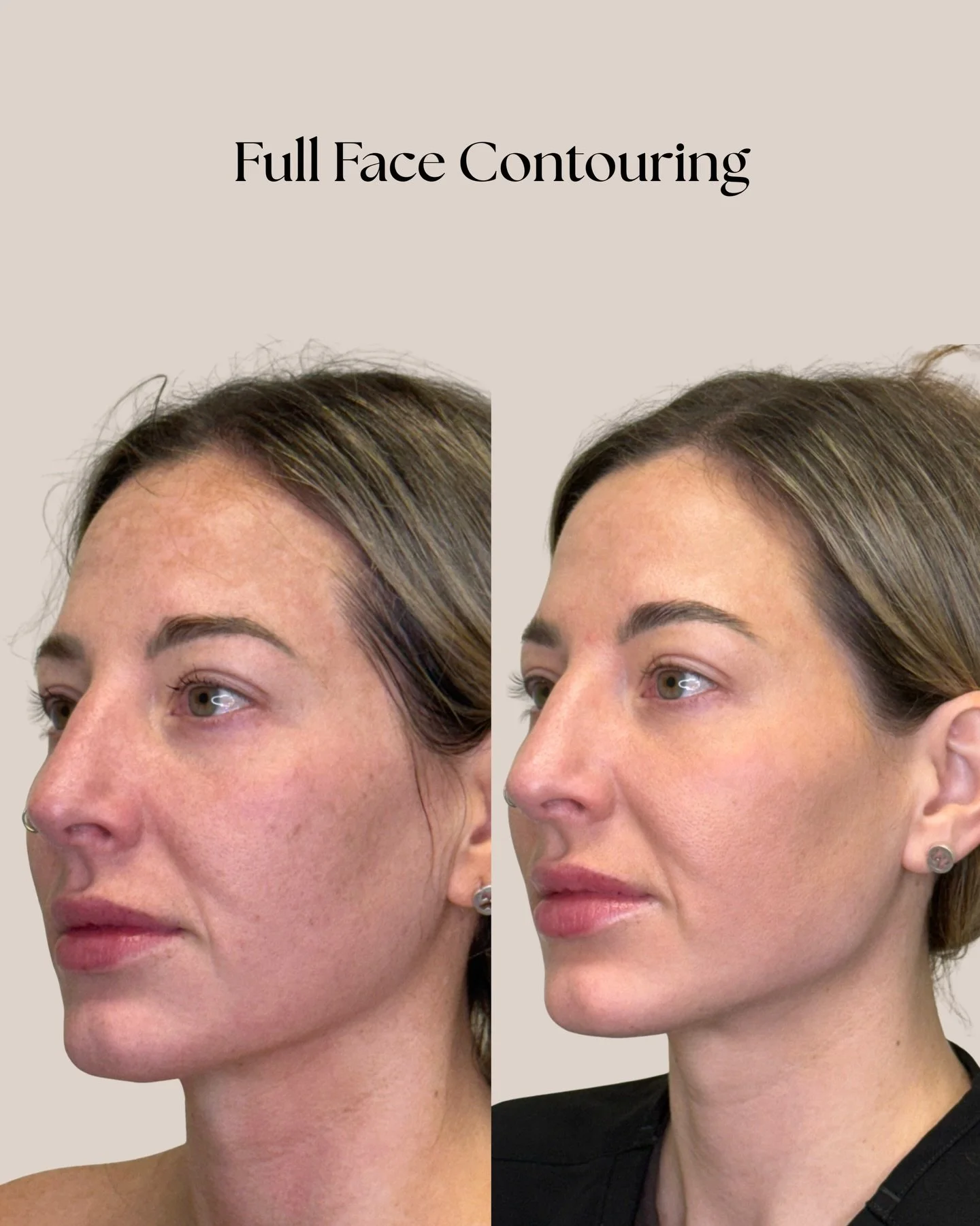 Full face contouring, but make it natural. Enhanced contours, softened lines, and results that age beautifully &mdash; never overdone.