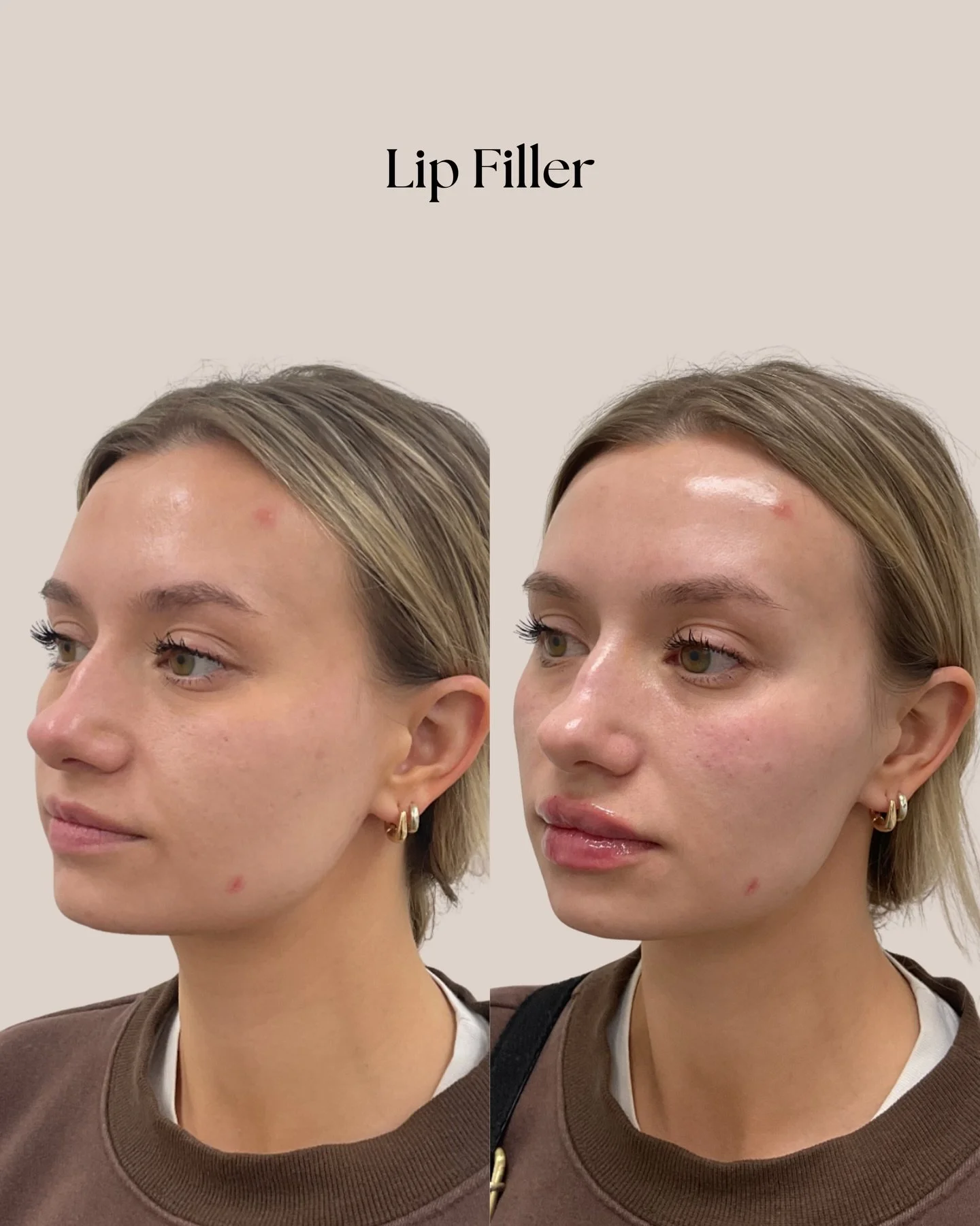 The lip filler before &amp; after transformation of our dreams😍 Valentine&rsquo;s Day lips, incoming 💋Book this week to look your best just in time. Enjoy $100 off lip filler + a free Revision Youthful Lip Replenisher, because your lips deserve a l