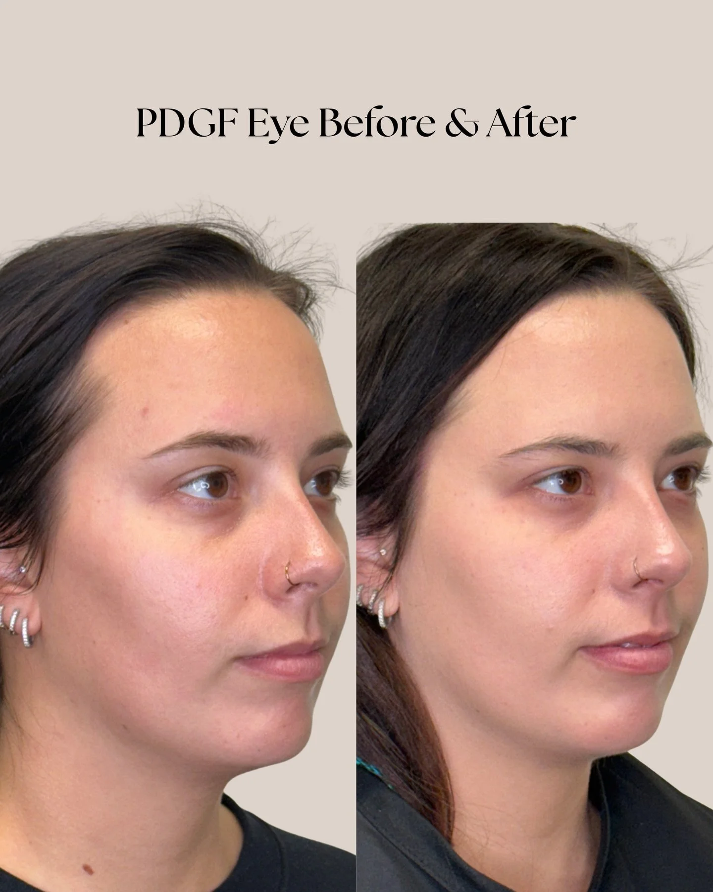 The under-eye area is one of the first places to show aging&mdash;and one of the hardest to treat. PDGF works at a cellular level to repair and rebuild skin, improving texture, fine lines, and overall brightness.