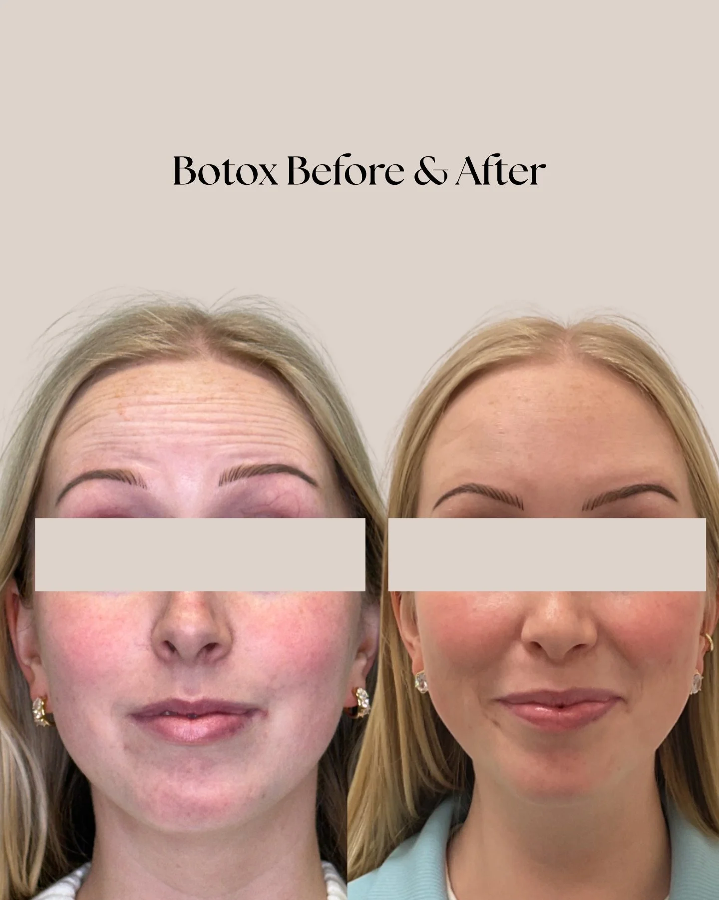 That fresh Botox feeling though🤌🏻✨🤍