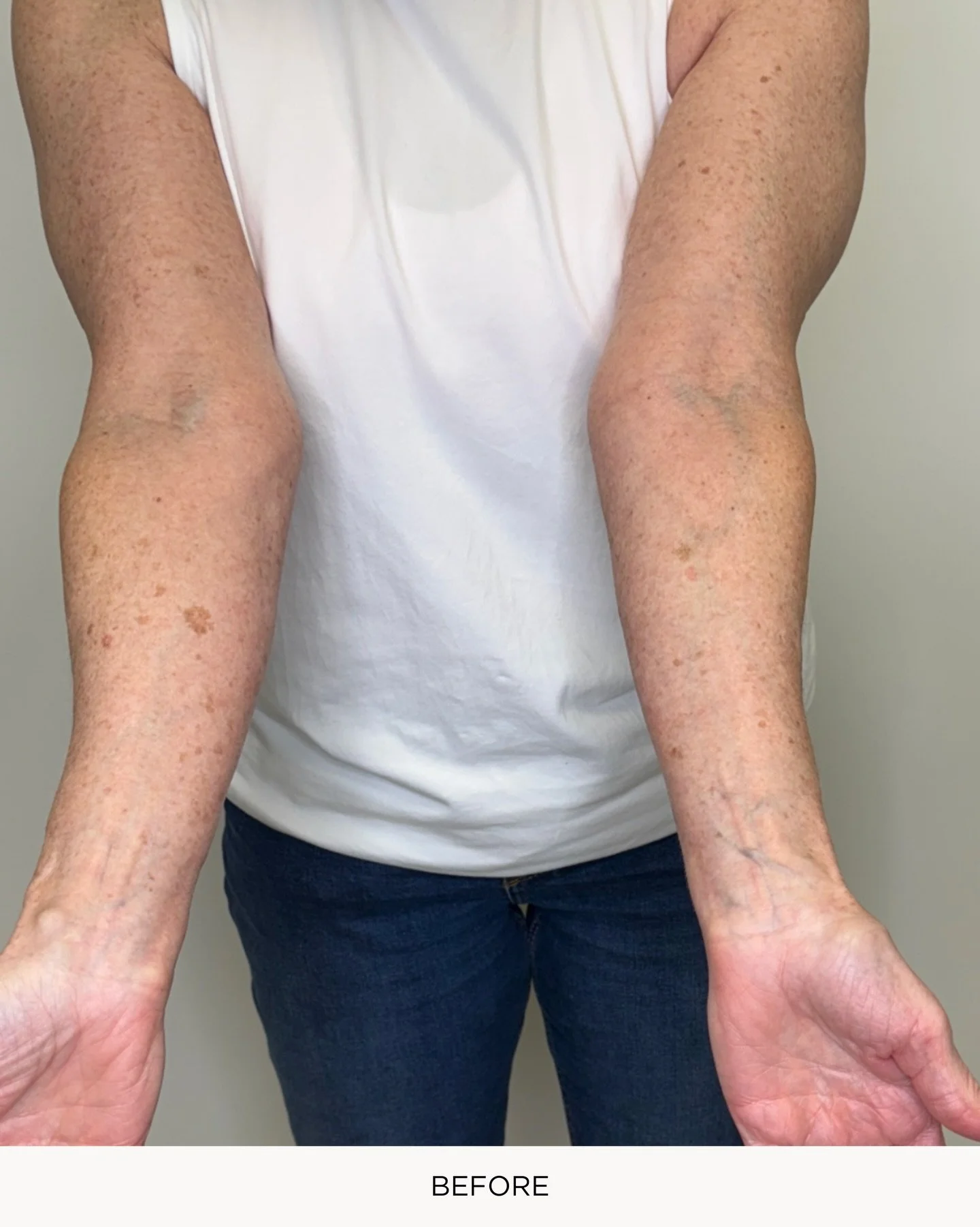 Sun damage, texture, and discoloration on the arms are so common, but the right laser combo can make a huge difference. ✨

MOXI + BBL on the arms helps improve:
&bull; Sun spots &amp; pigmentation
&bull; Uneven tone
&bull; Rough texture
&bull; Early 