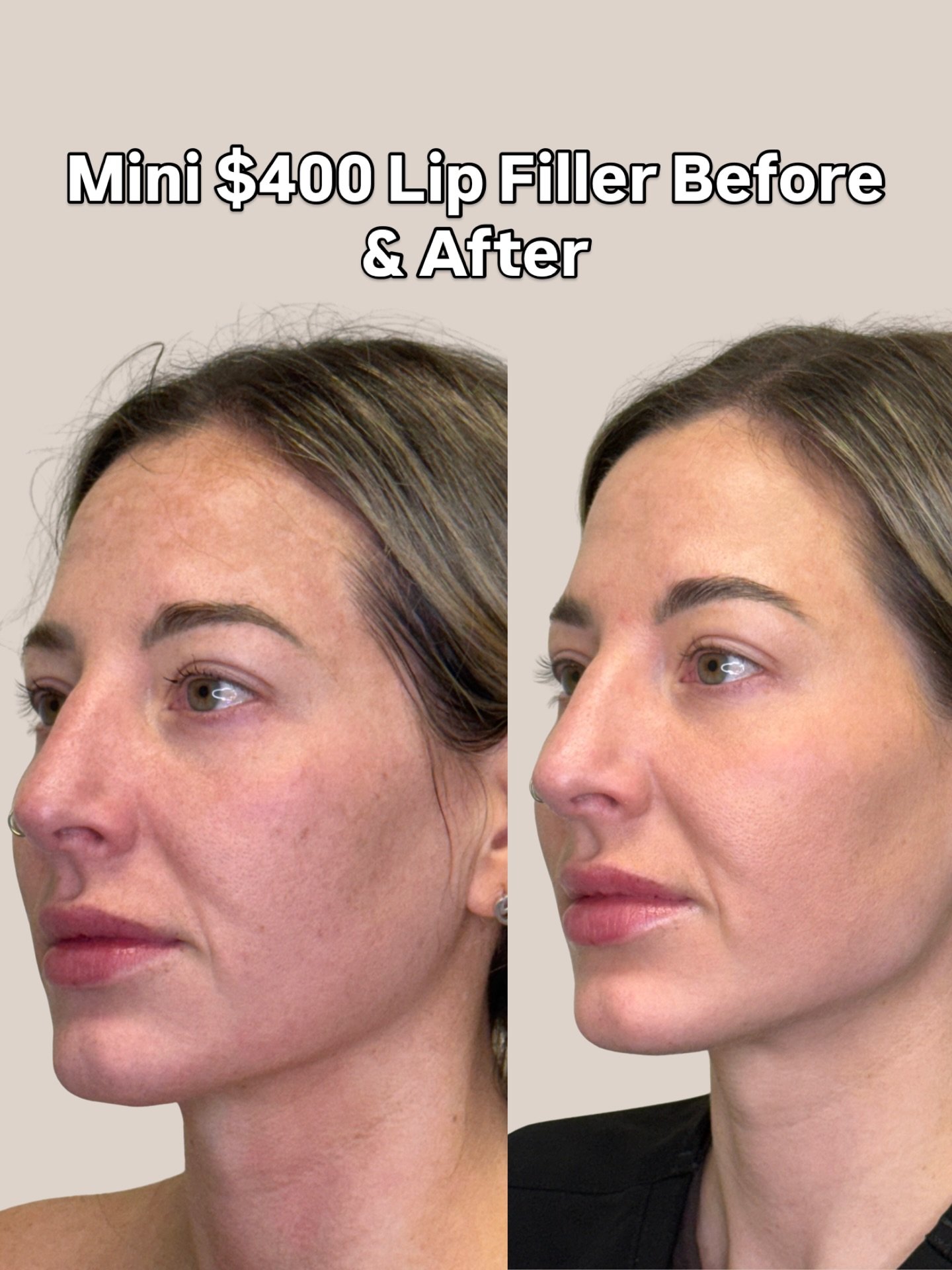 Our Mini Lip Refresh is just $400 &mdash; the perfect way to add a subtle pop while keeping everything soft, natural, and you. Whether you want a little hydration, a touch of volume, or just a refresh, this treatment is designed to enhance what you a