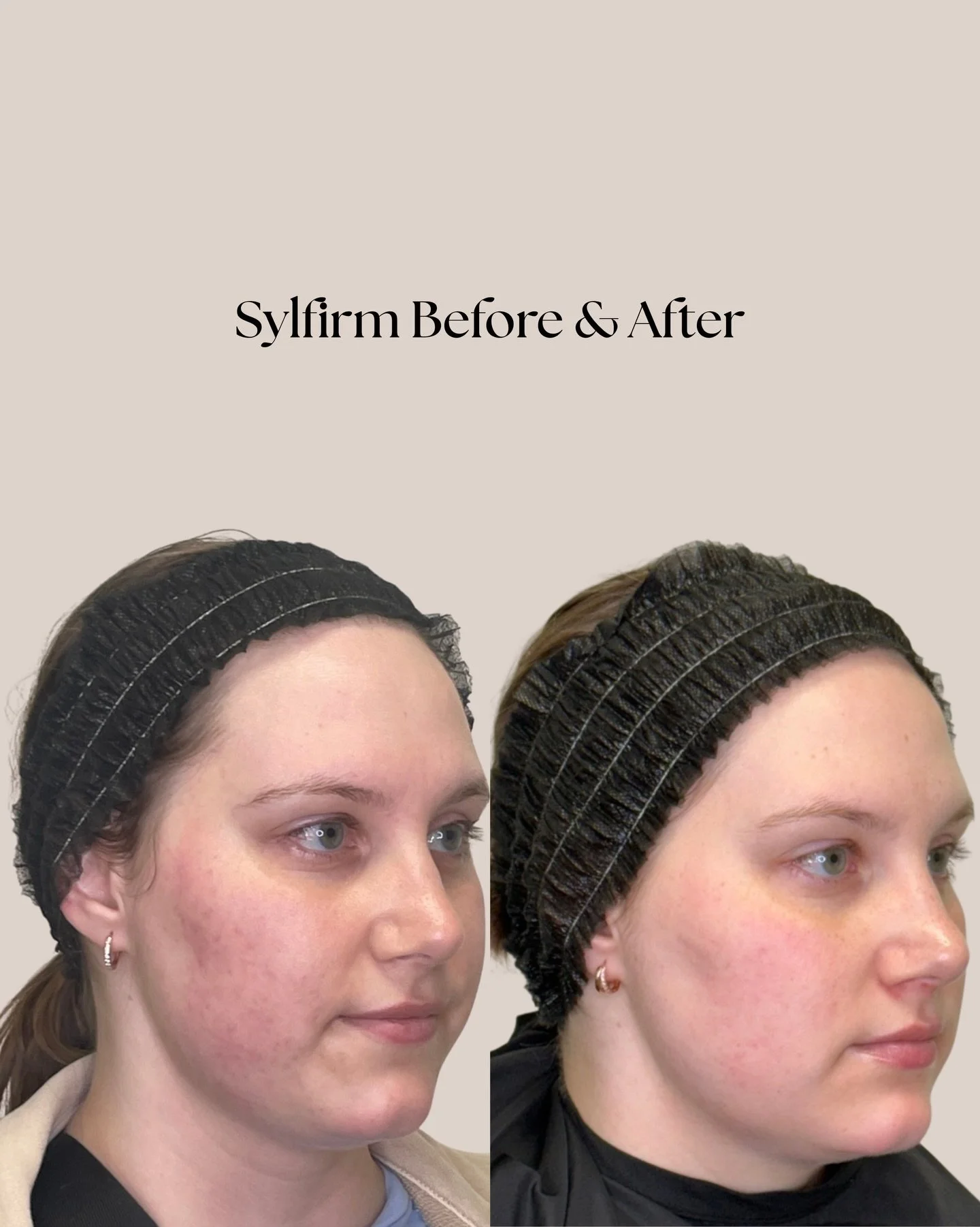 The Sylfirm working its magic!✨🤍