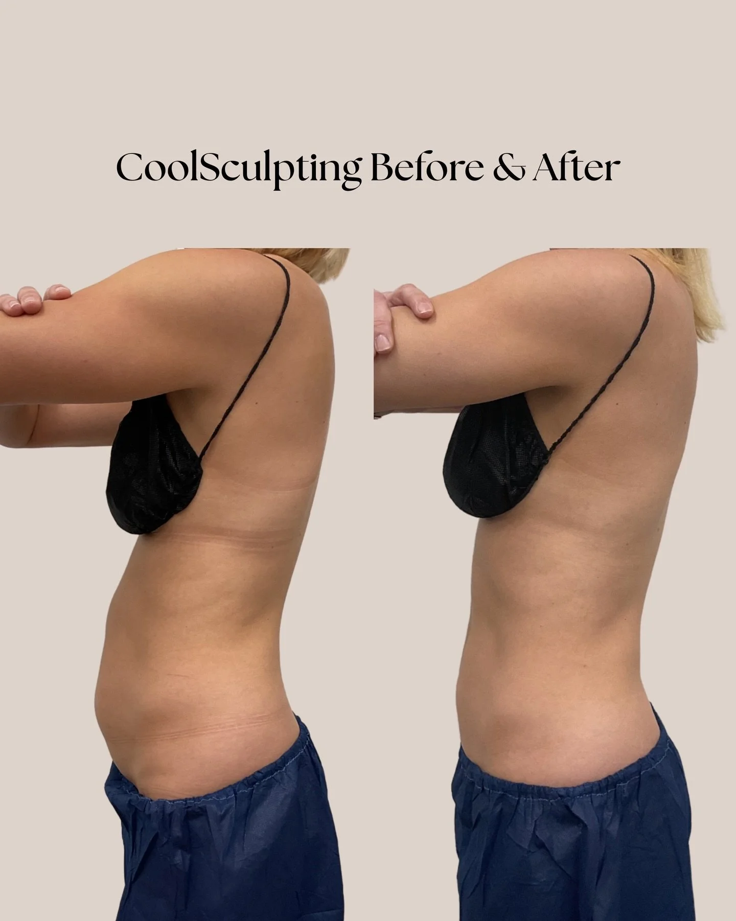 This CoolSculpting before &amp; after says it all. Stubborn areas can finally be treated to completion with a customized plan designed just for you.

Treat your areas to completion while staying comfortable with cozy blankets, pillows, streaming serv