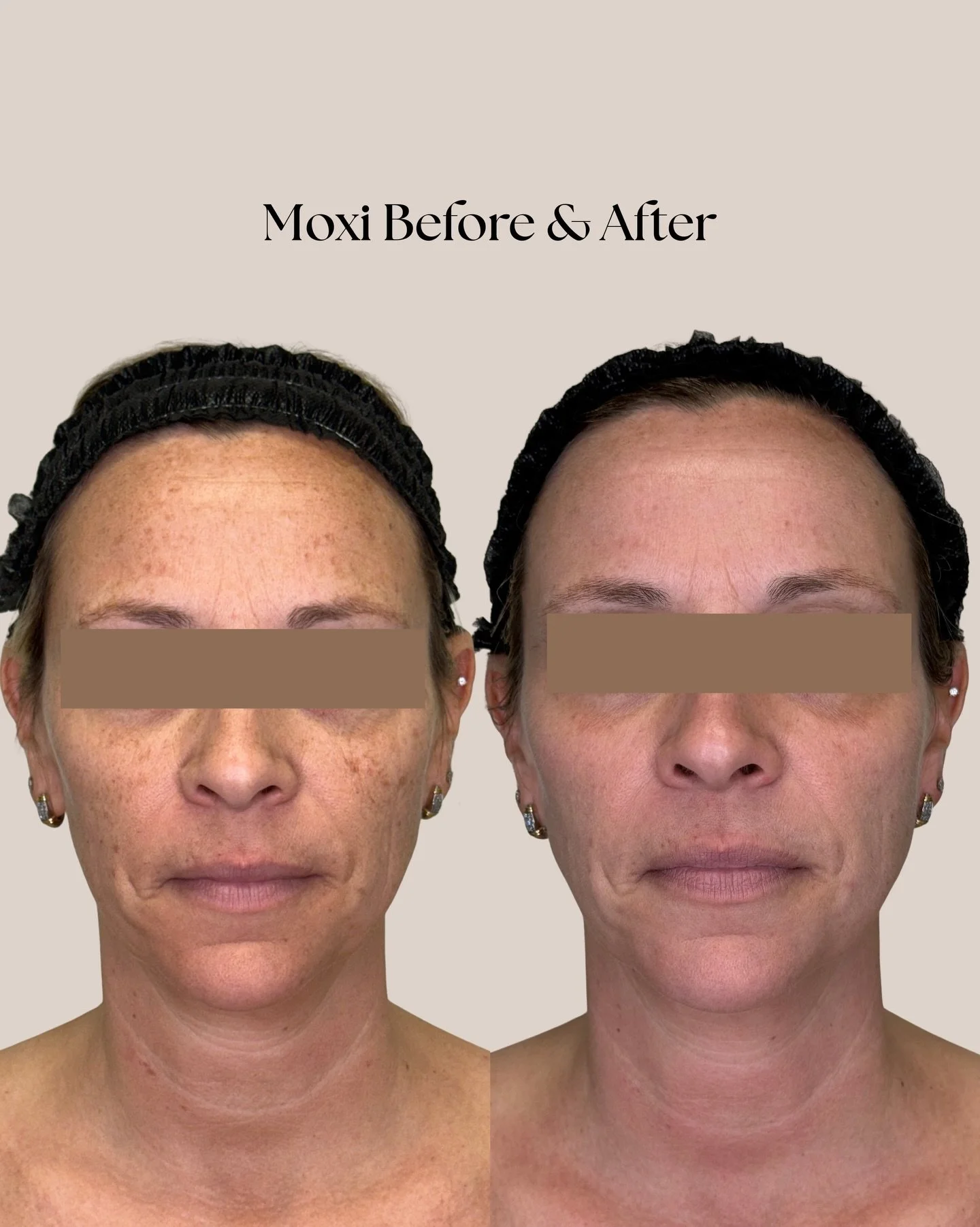 Moxi magic ✨ Just one treatment made a visible difference in overall tone, texture, and sun damage. Moxi is perfect for improving pigmentation, softening fine lines, and giving skin that fresh, healthy glow, with minimal downtime.

Whether you&rsquo;