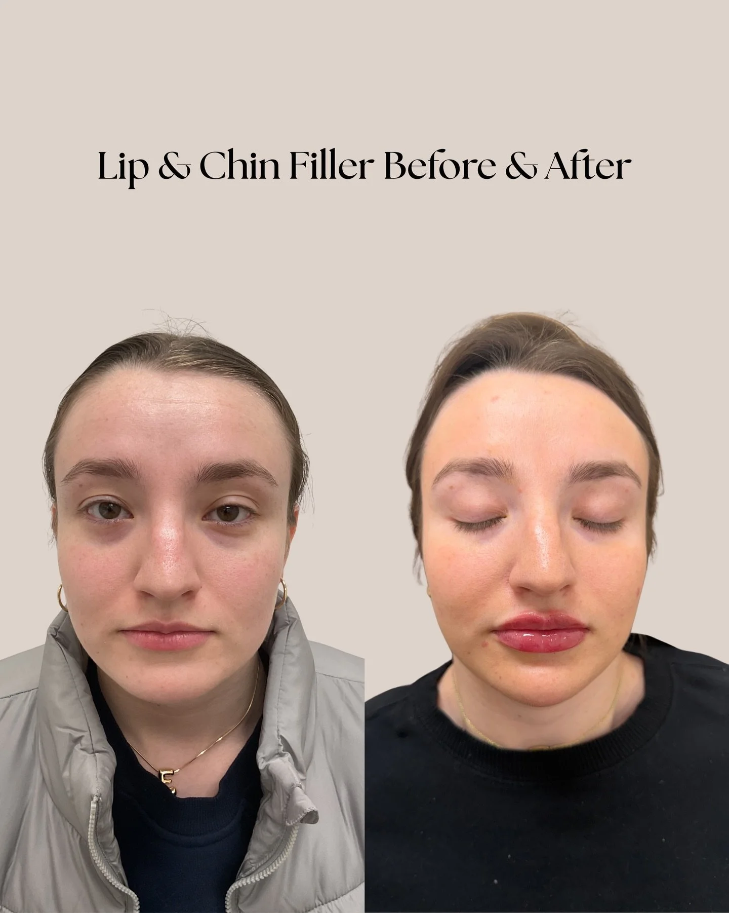 Lip &amp; Chin Filler Before &amp; After👄✨The most natural plump🤍