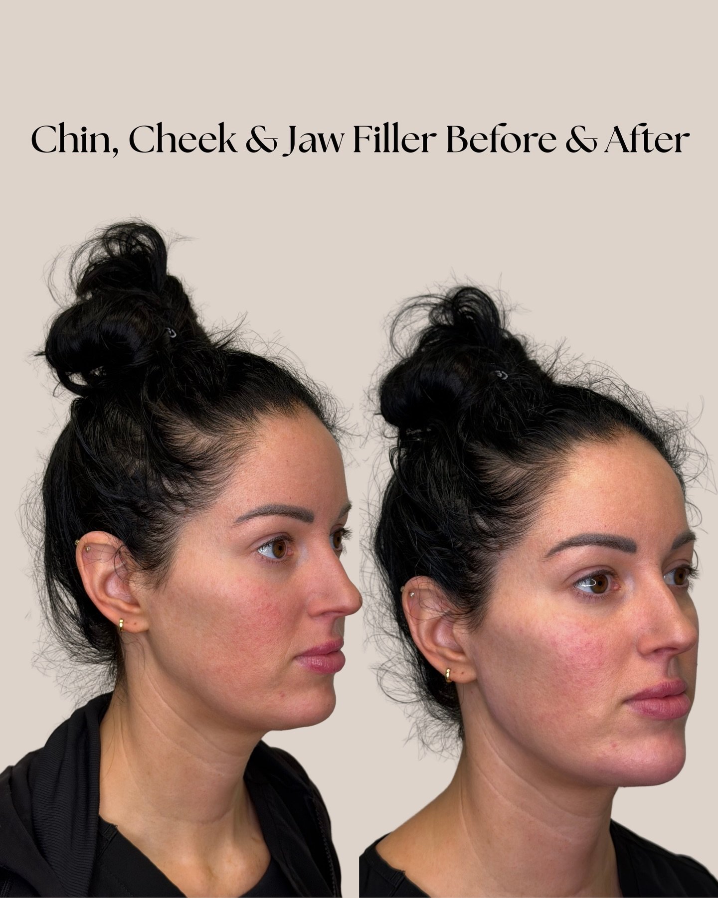 Cheek, chin &amp; jaw filler! A full face contouring never hurt anybody🤍✨