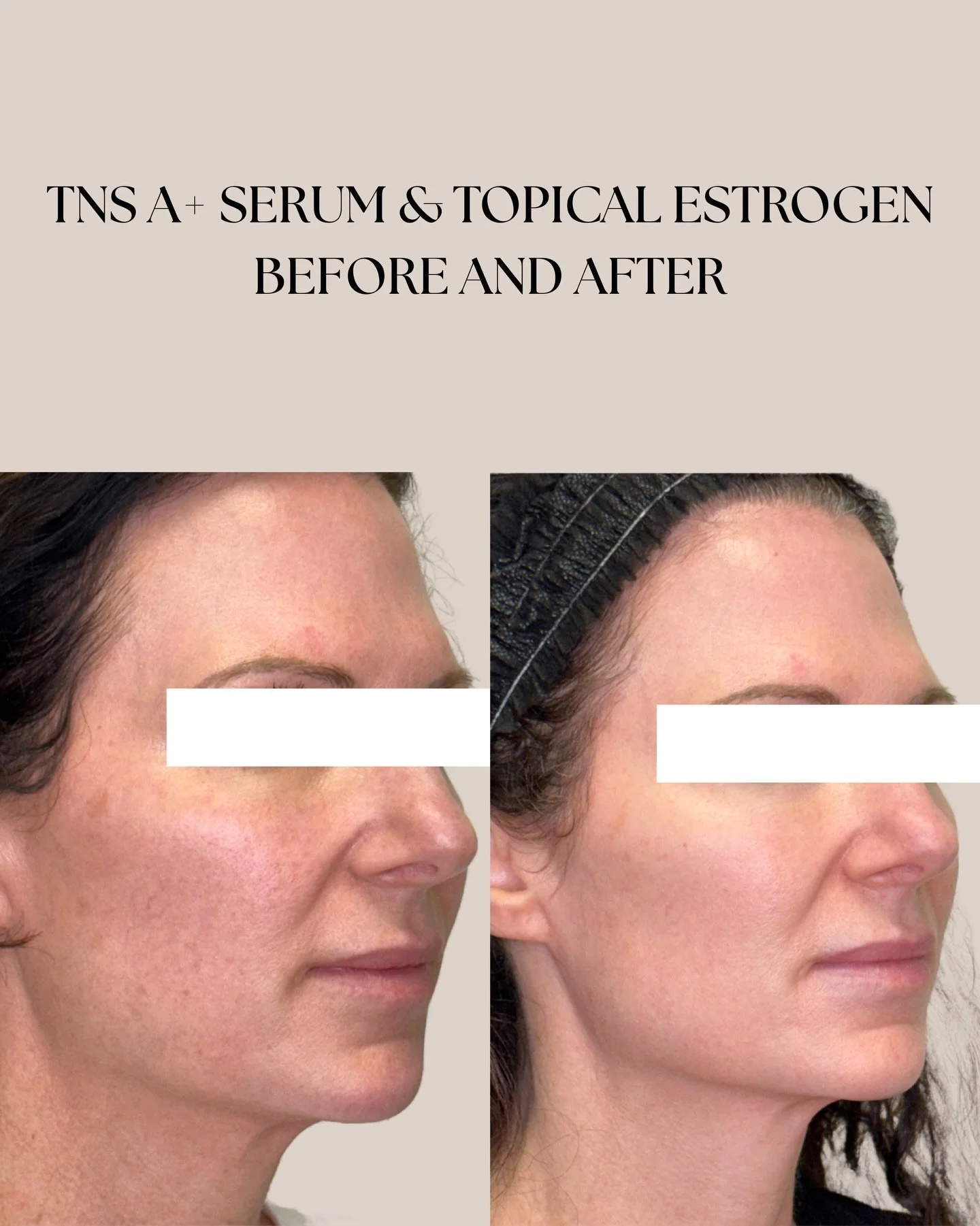 Skincare before &amp; after🤍✨ A good skincare routine seriously changes the game!