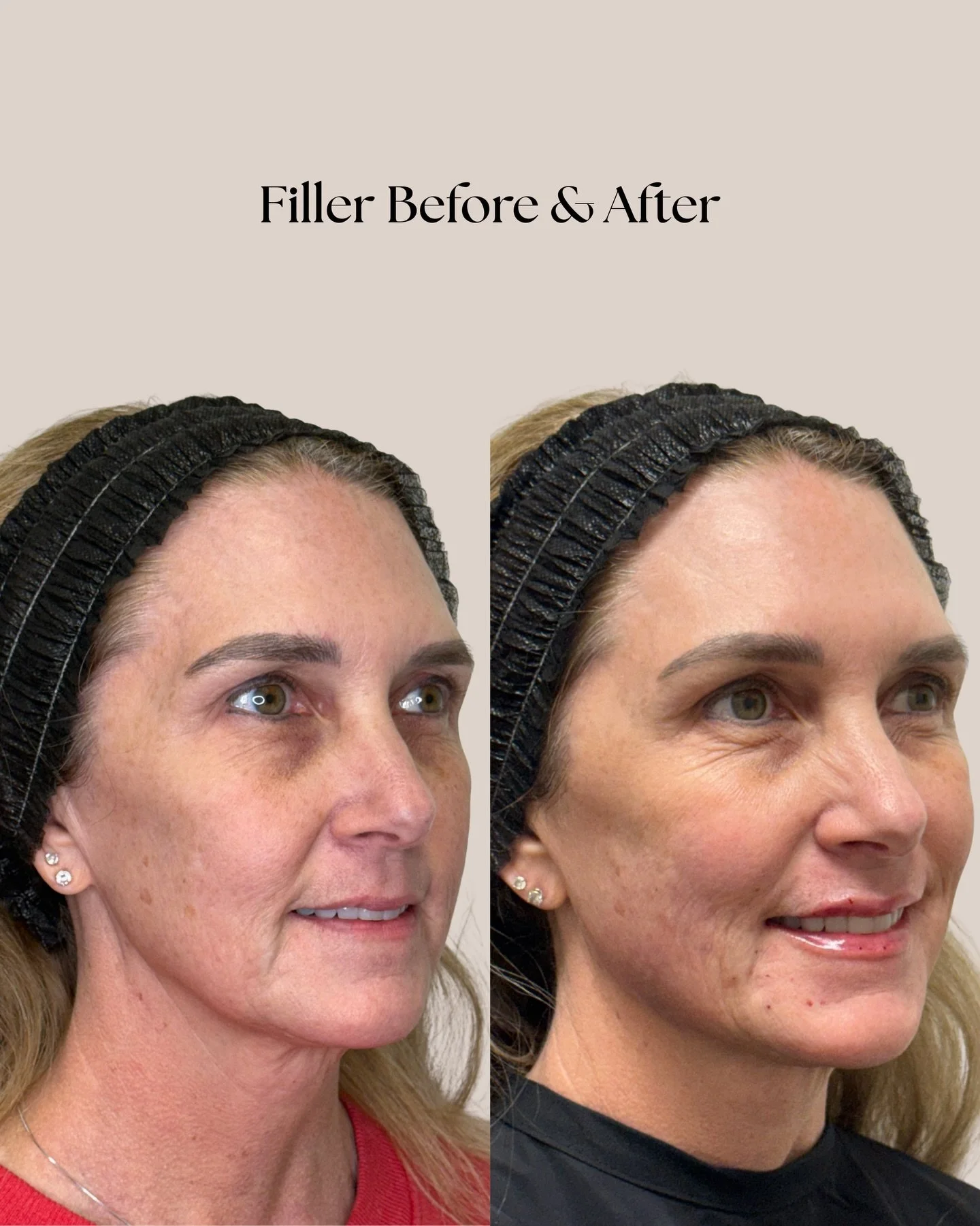 A little filler refresh goes a long ways🤍Such a subtle touch that makes such an amazing difference!