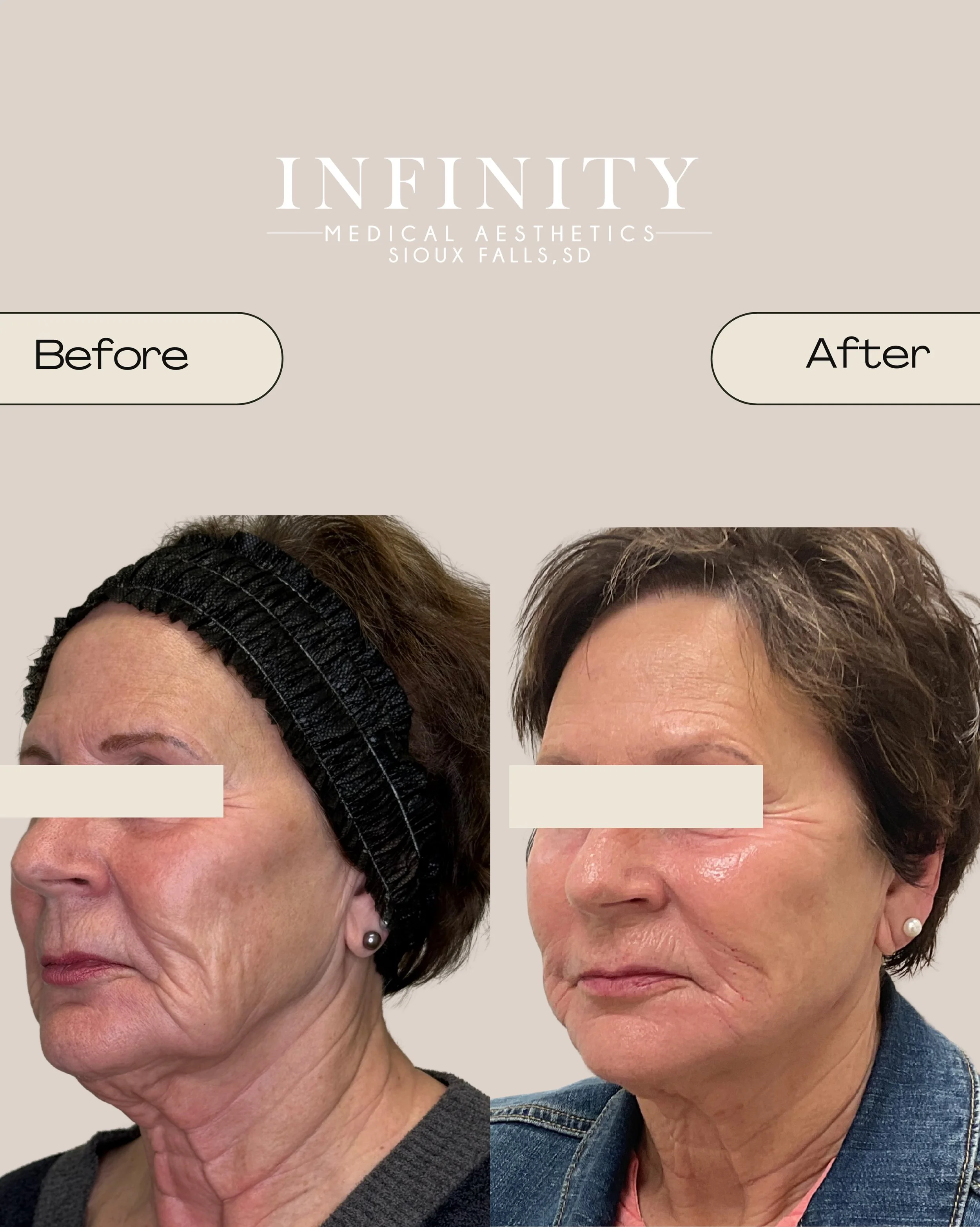Full face filler before &amp; after🤍The glow up!!✨

#filler #fillerbeforeandafter #beforeandafter #medicalaesthetics #medspa