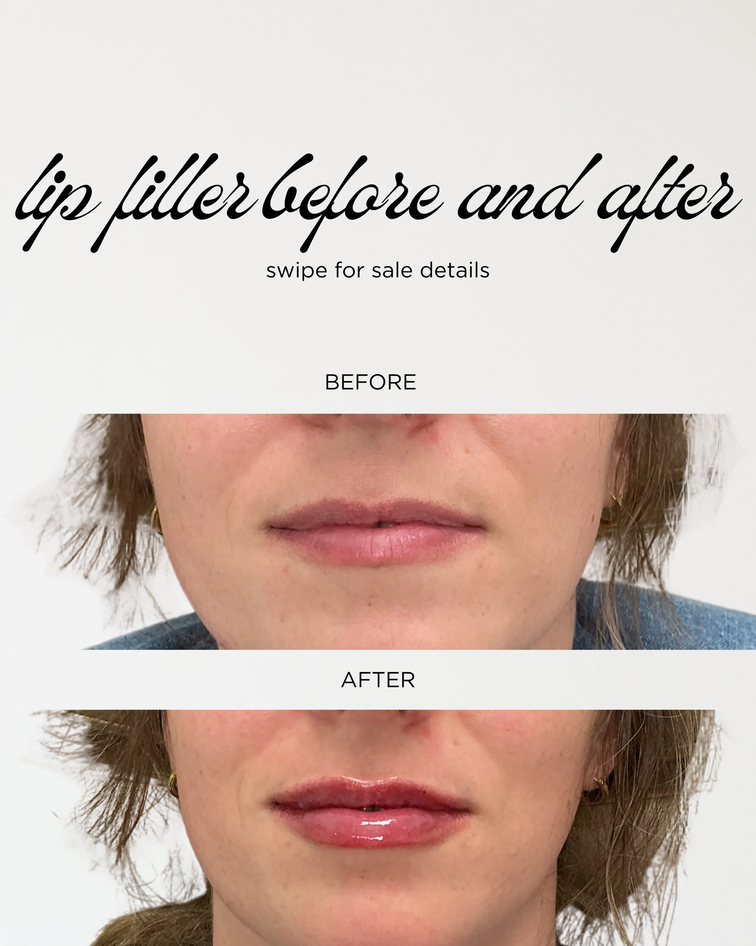 A subtle enhancement can make all the difference. ✨Our Anniversary Sale is officially here! Buy One, Get One 50% Off!

Perfect for anyone looking to enhance, refresh, or maintain their results. Swipe for the sale details and check out this beautiful 