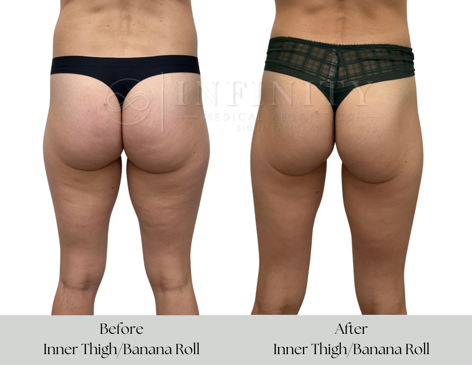 Side-by-side comparison of a shirtless man before and after a full abdomen transformation, showing a flatter stomach on the right.