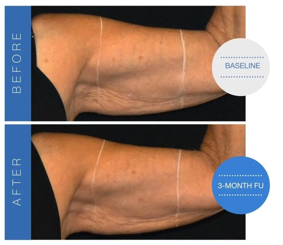 Side-by-side comparison of a woman's abdomen before and after weight loss, showing a significant reduction in abdominal size. The 'before' photo shows a larger, rounded abdomen, while the 'after' photo shows a slimmer waistline with visible muscle tone.