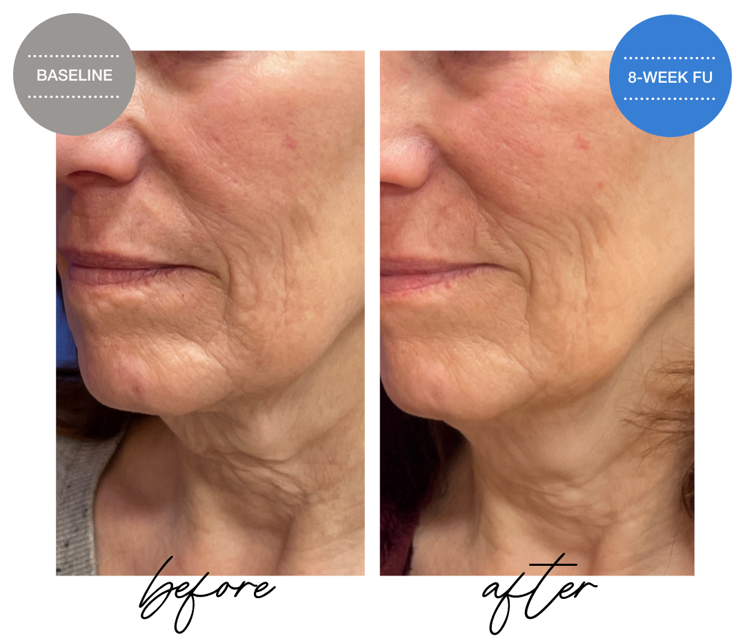 Side-by-side comparison of a woman’s profile before and after jawline treatment. The left shows the woman in June with a less defined jawline, and the right shows her 30 days later with a more sculpted jawline. Both images highlight changes in facial contour.