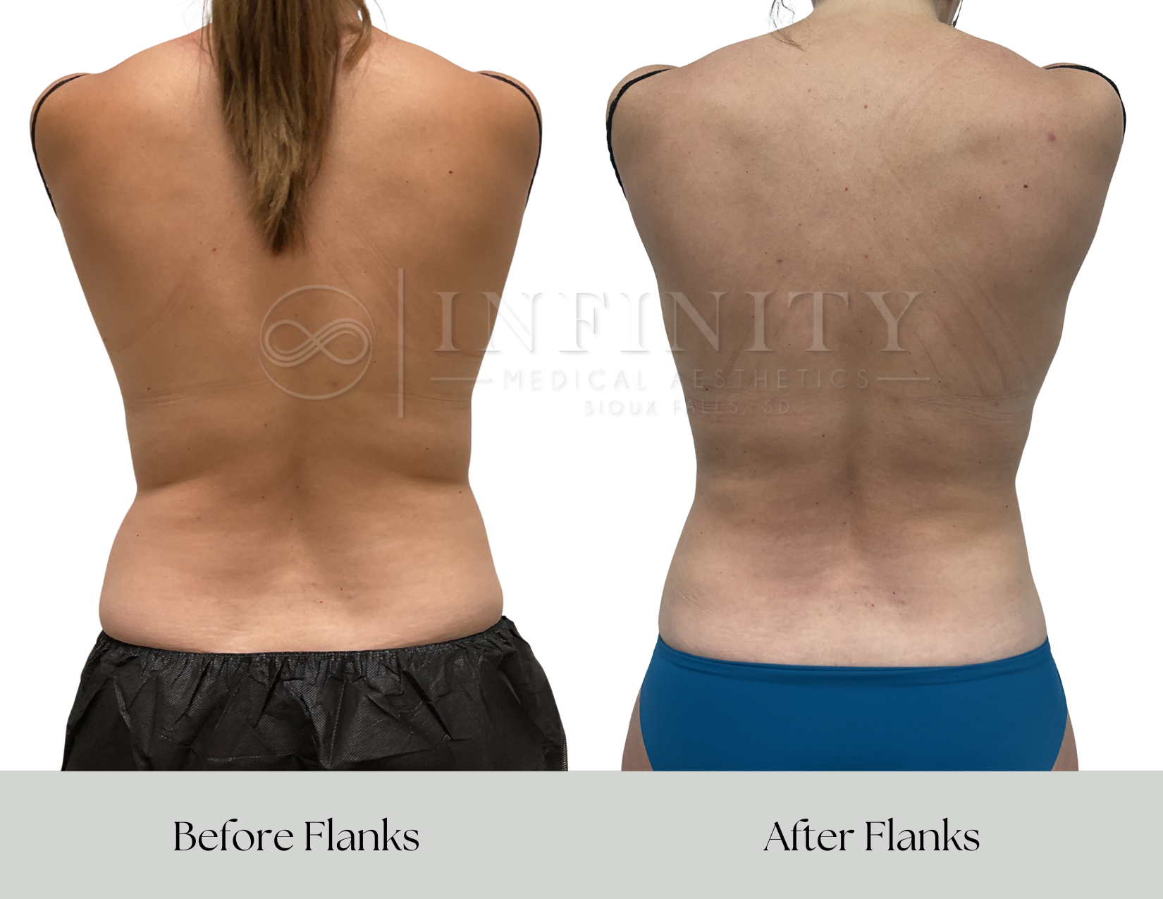 Side-by-side comparison of a woman's back labeled 'Before Flanks' on the left, showing more love handles, and 'After Flanks' on the right, showing a more contoured waistline after treatment.
